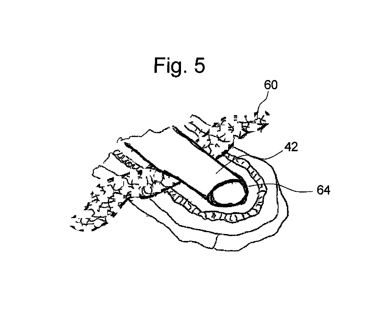 Conductive and degradable implant for pelvic tissue treatment