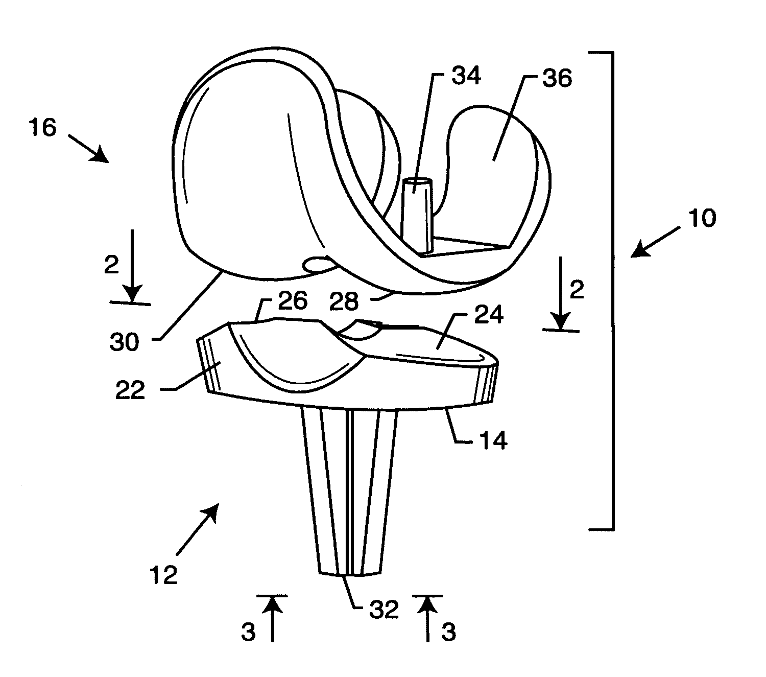 Knee prosthesis with ceramic tibial component