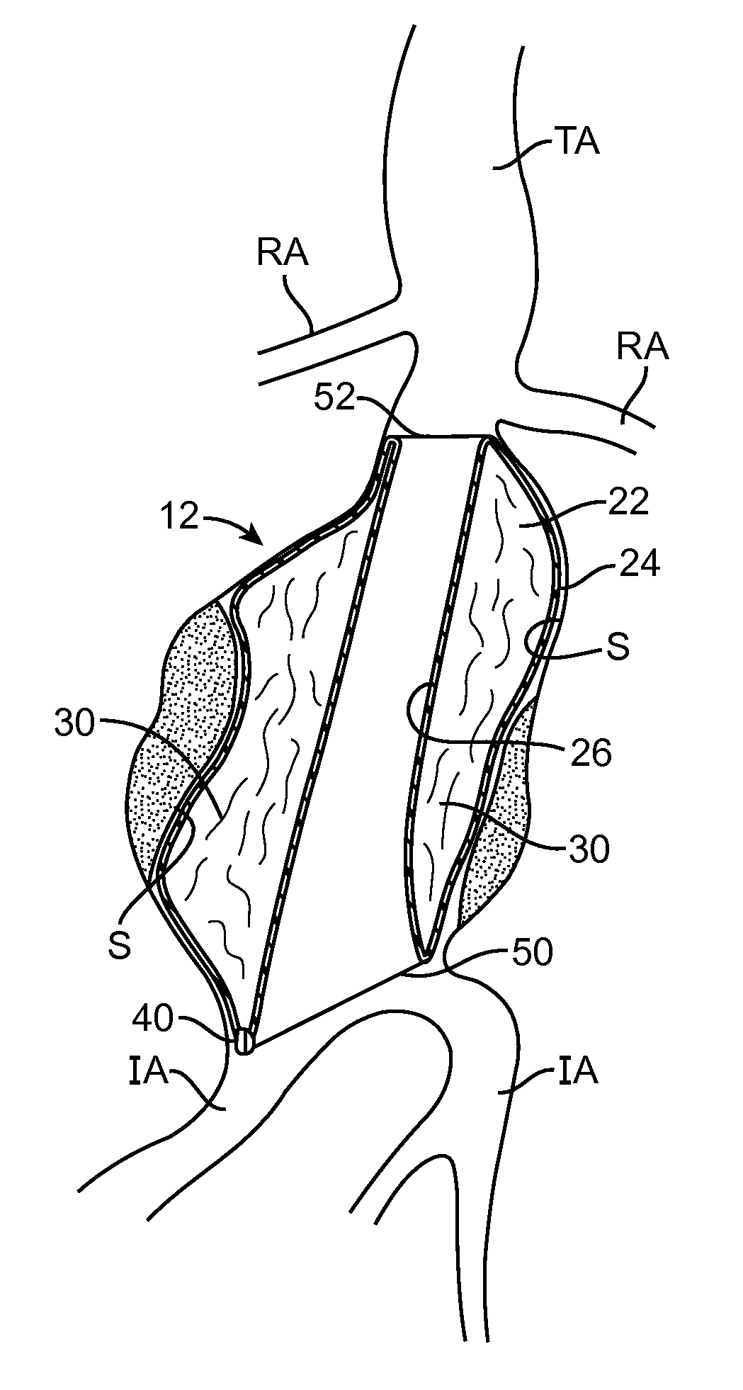 Graft systems having semi-permeable filling structures and methods for their use