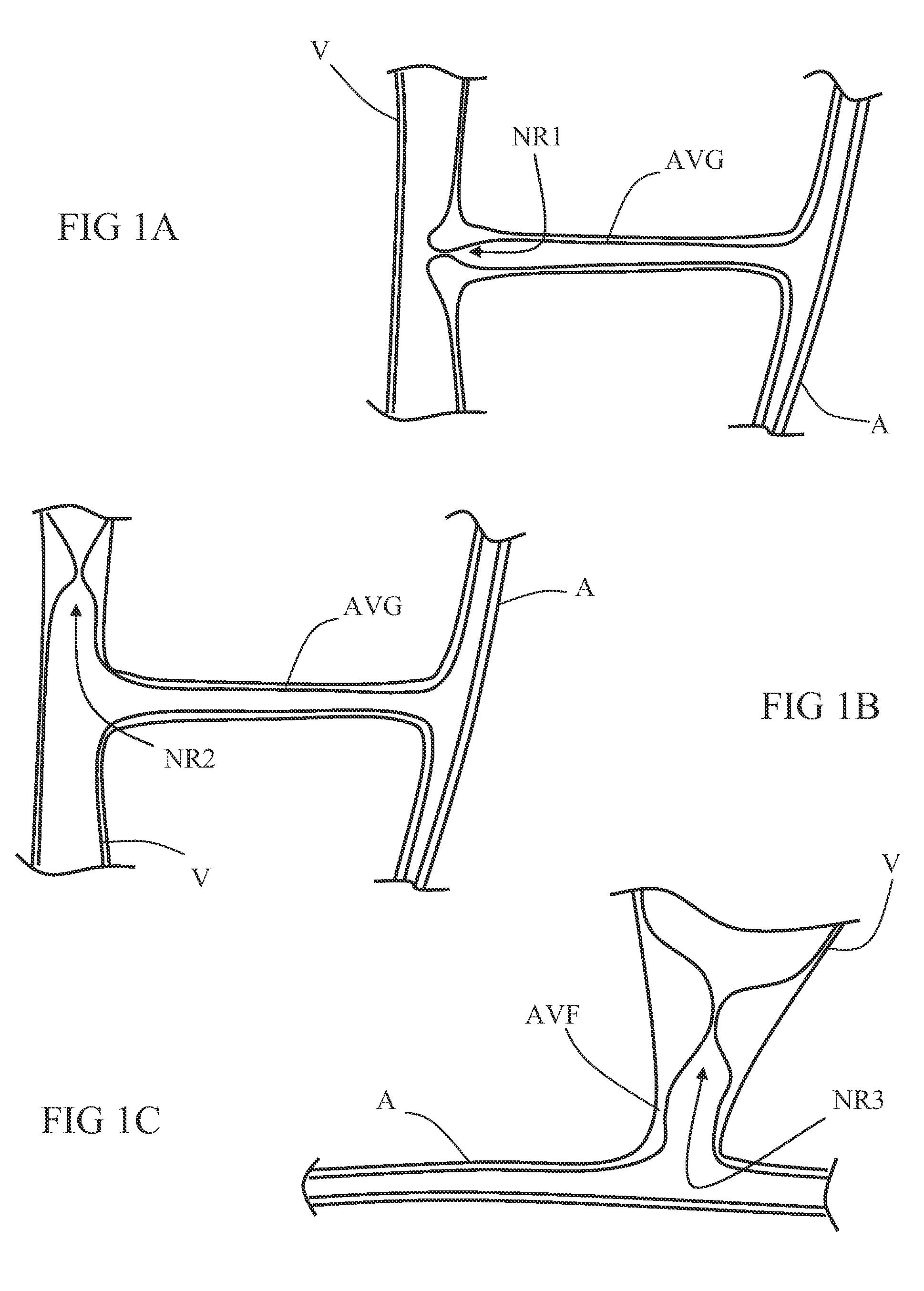 Systems for blood vessel dilatation and visualization