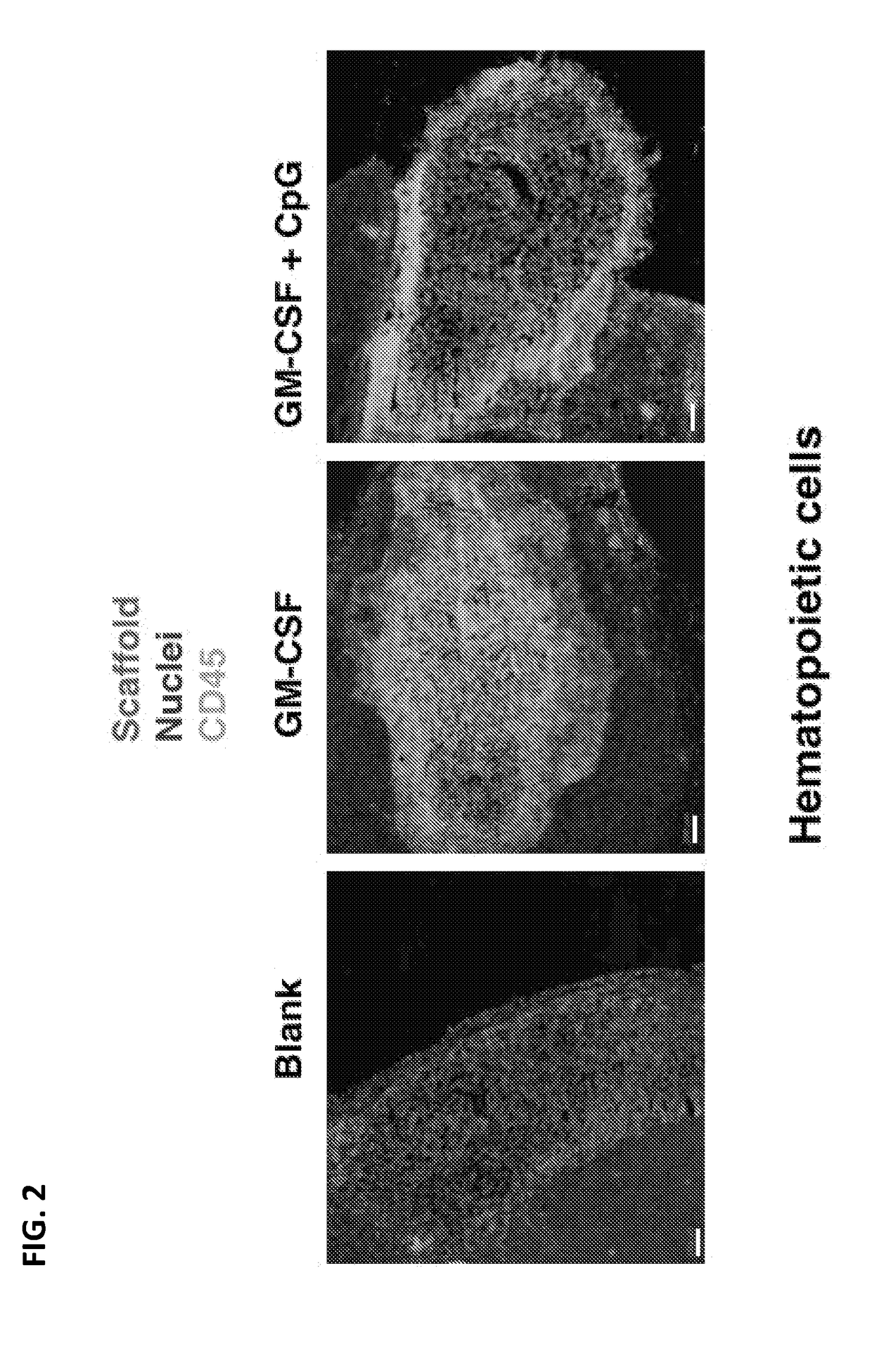 Peritumoral and intratumoral materials for cancer therapy