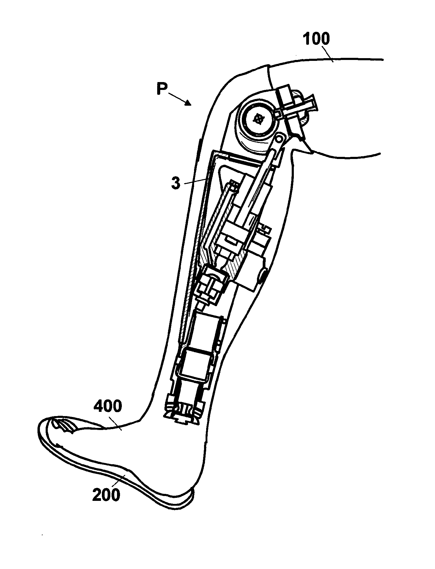 Automatic prosthesis for above-knee amputees