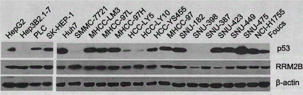 Application of RRM2B gene or protein thereof in metastasis of hepatocellular carcinoma