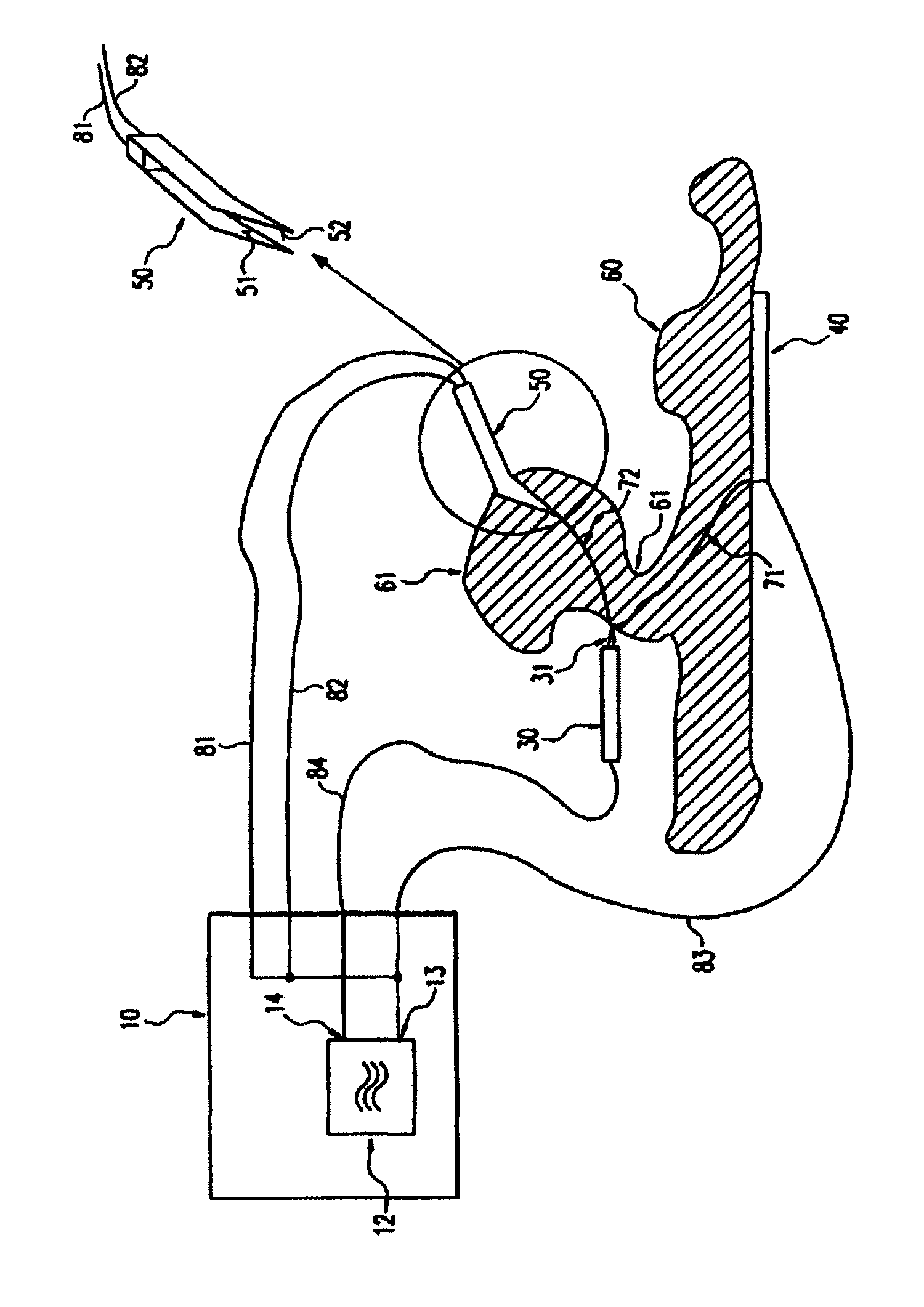 Electrosurgical hf generator