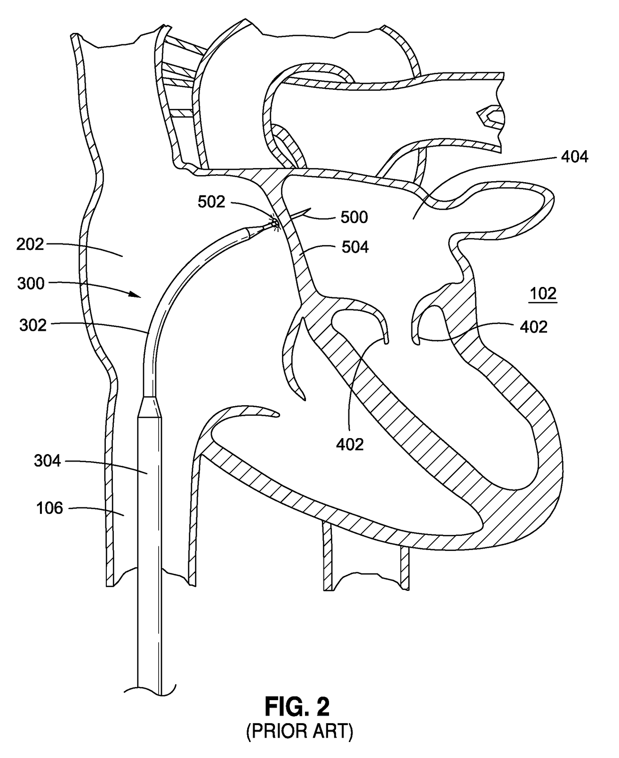 System and method for transcatheter heart valve platform