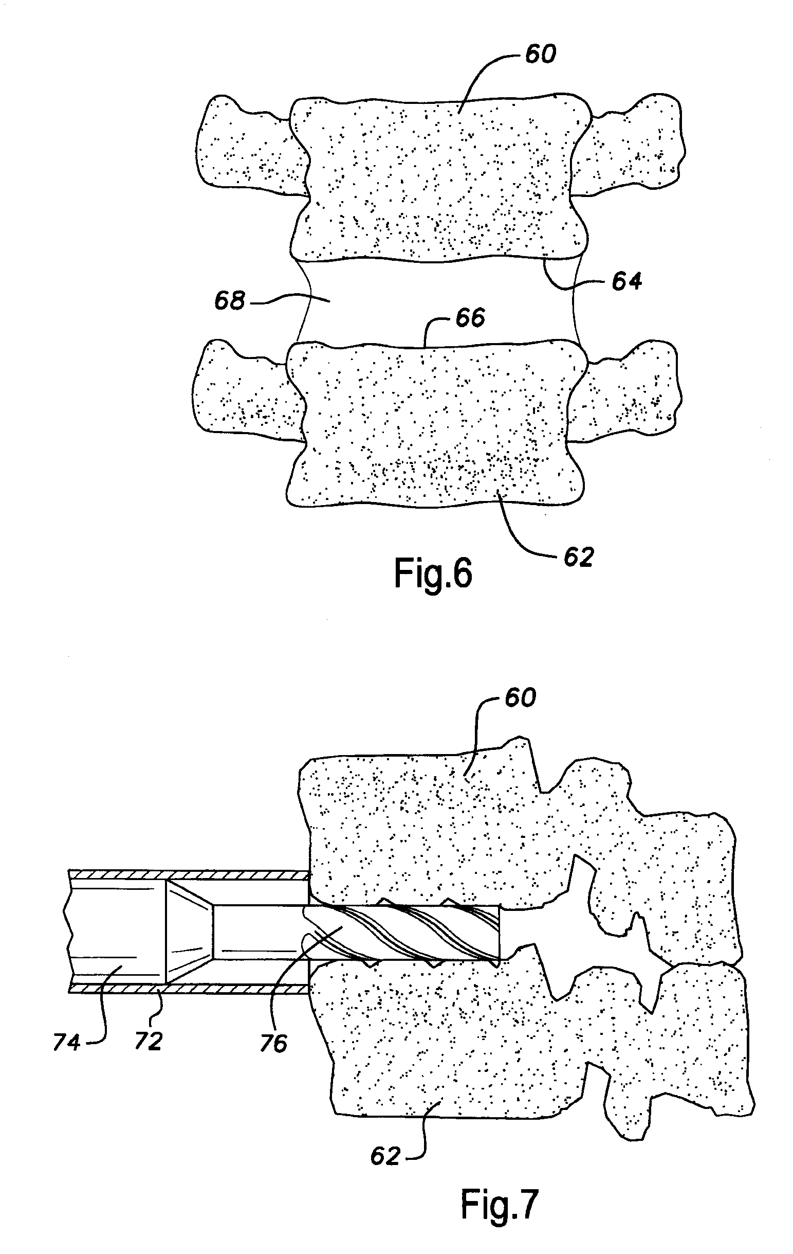 Arthrodesis of Vertebral Bodies