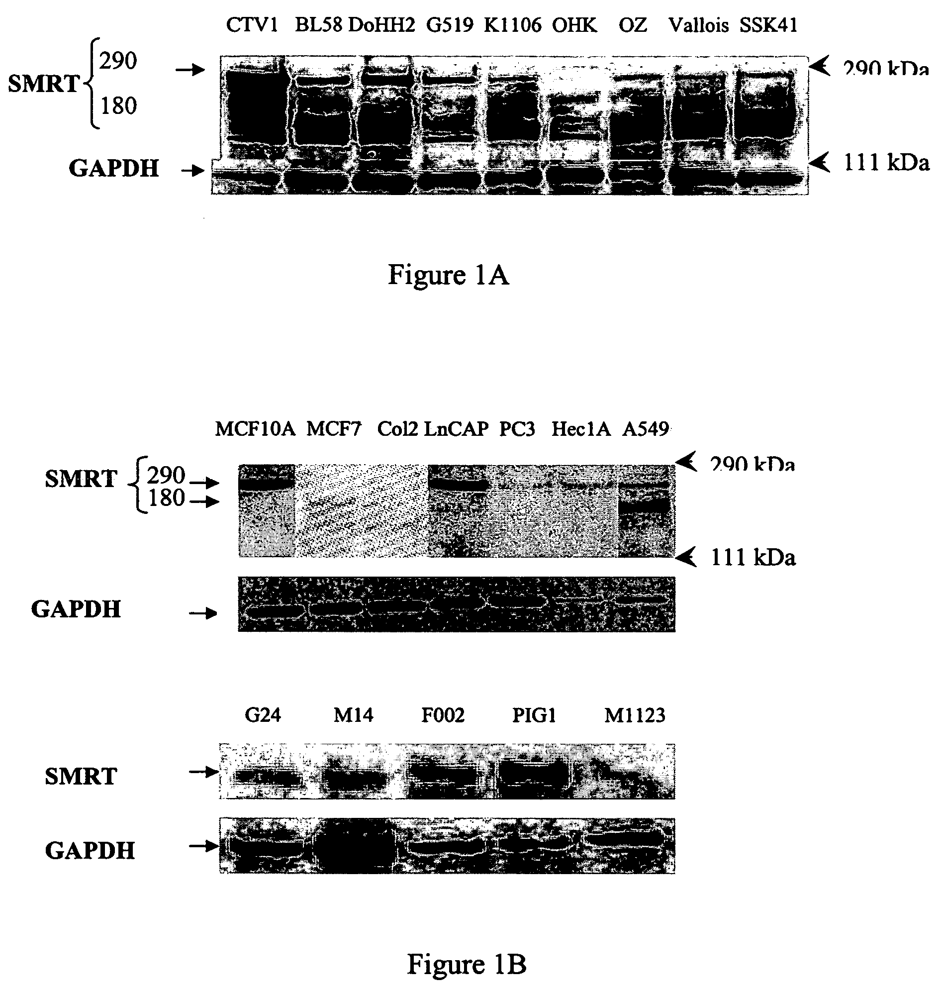 Method of prognosis of metastasis by detection of FRA12E fragile site within the SMRT gene/locus at chromosome 12q24