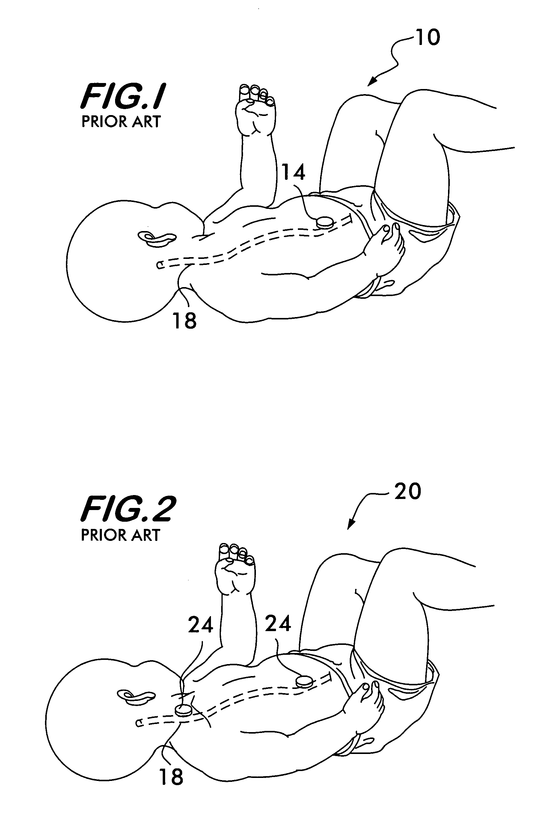 Cerebral spinal fluid shunt evaluation system