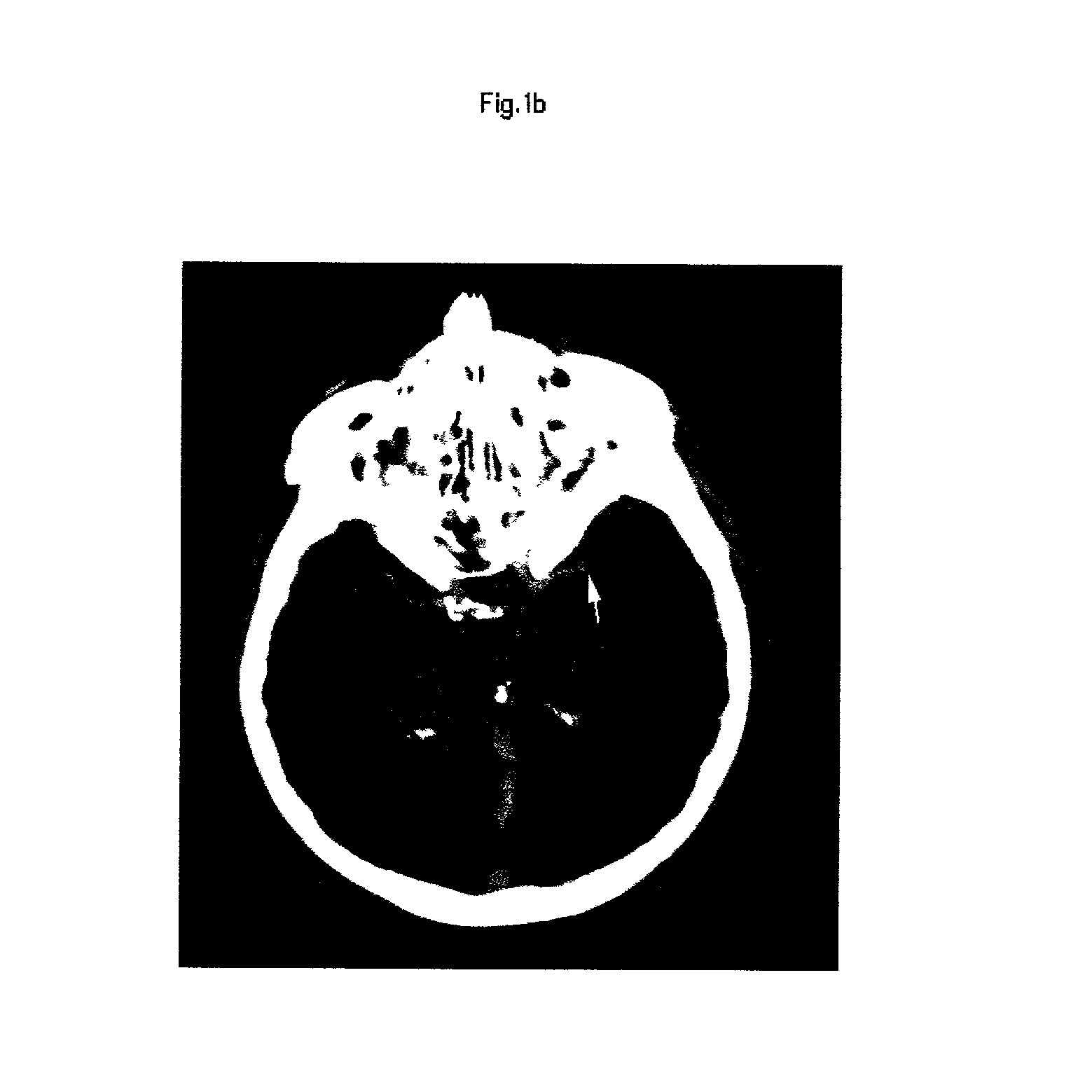 Method and apparatus for creating penumbra and infarct images