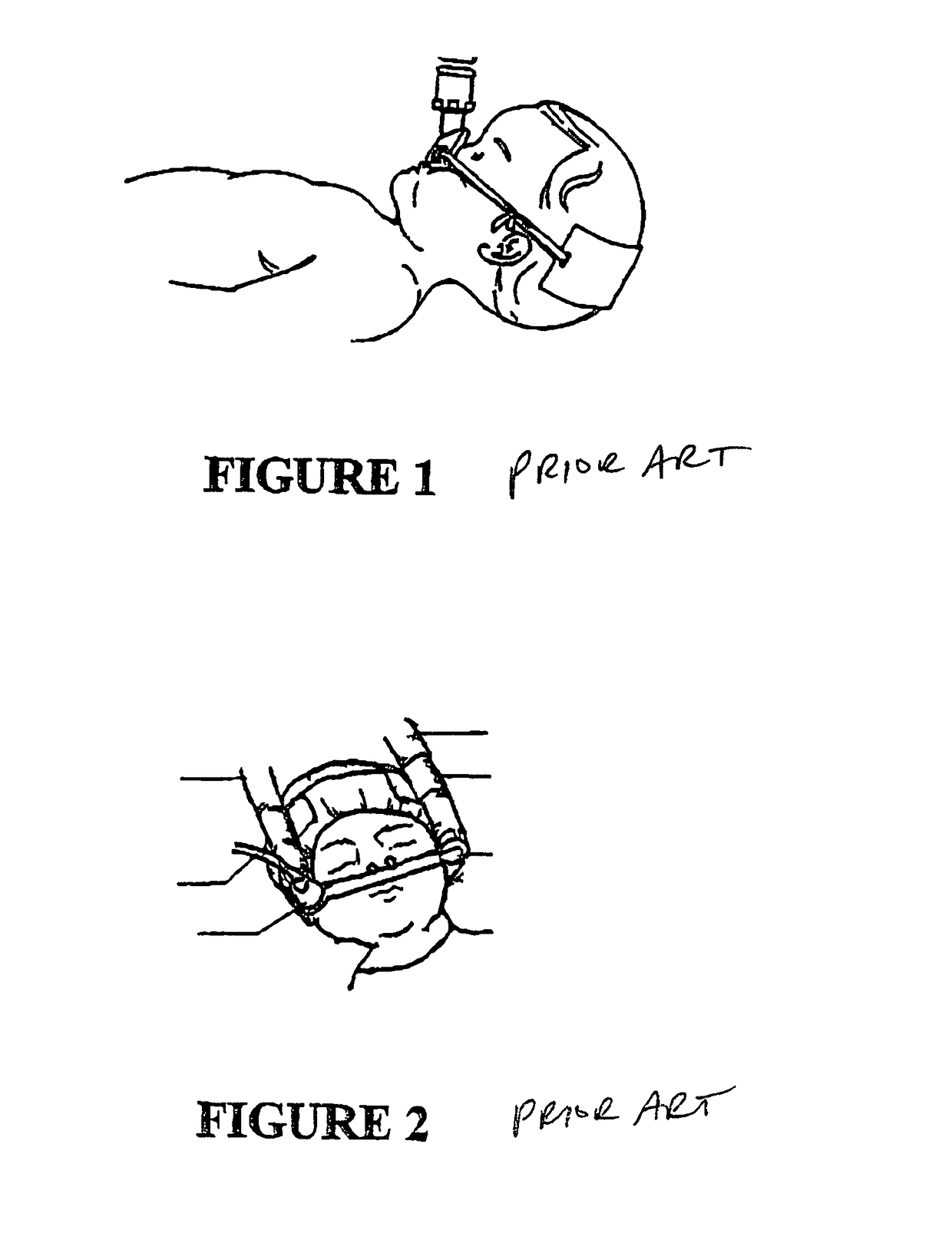 Breathing assistance apparatus