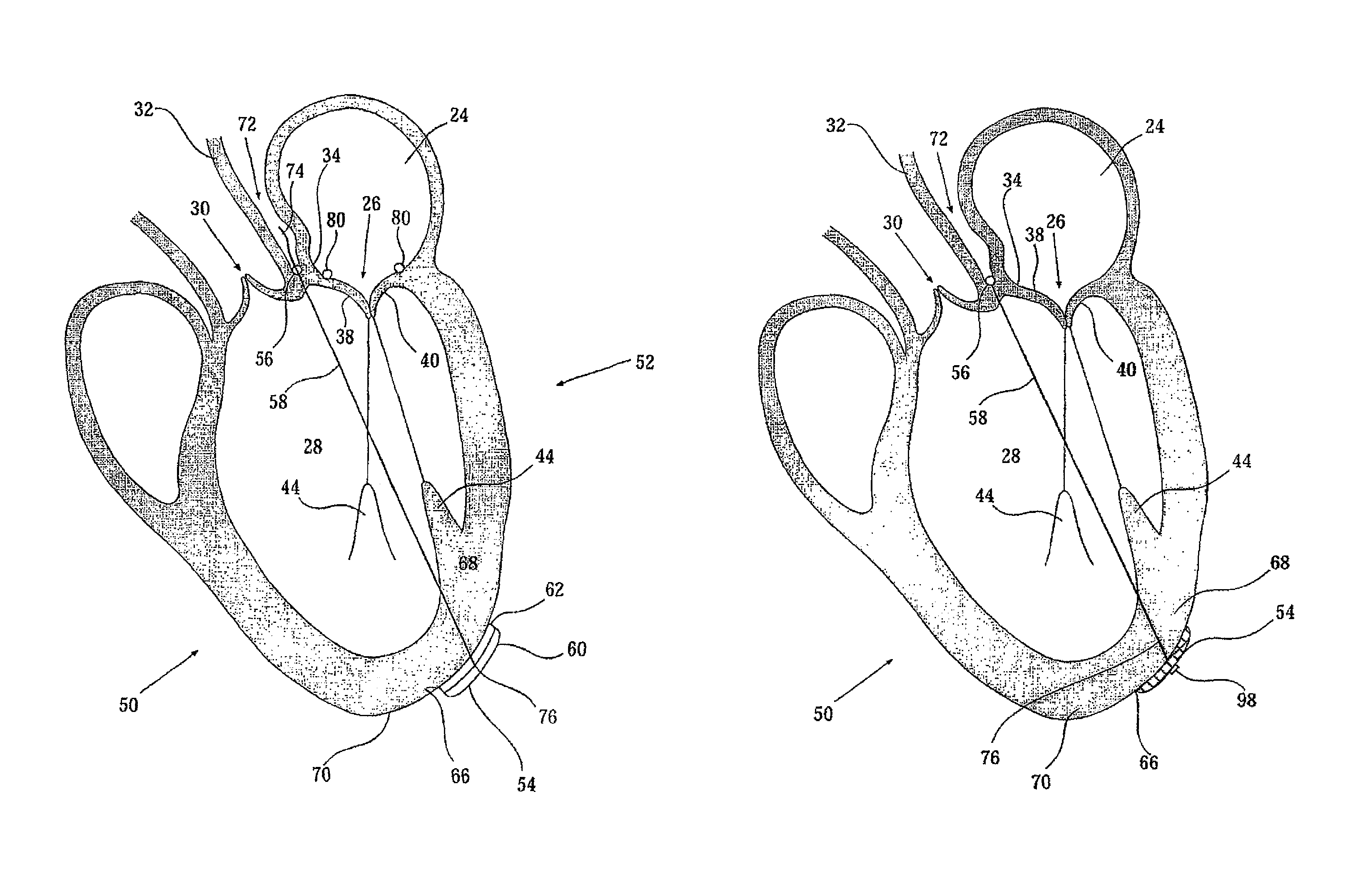 Elongated body for deployment in a heart