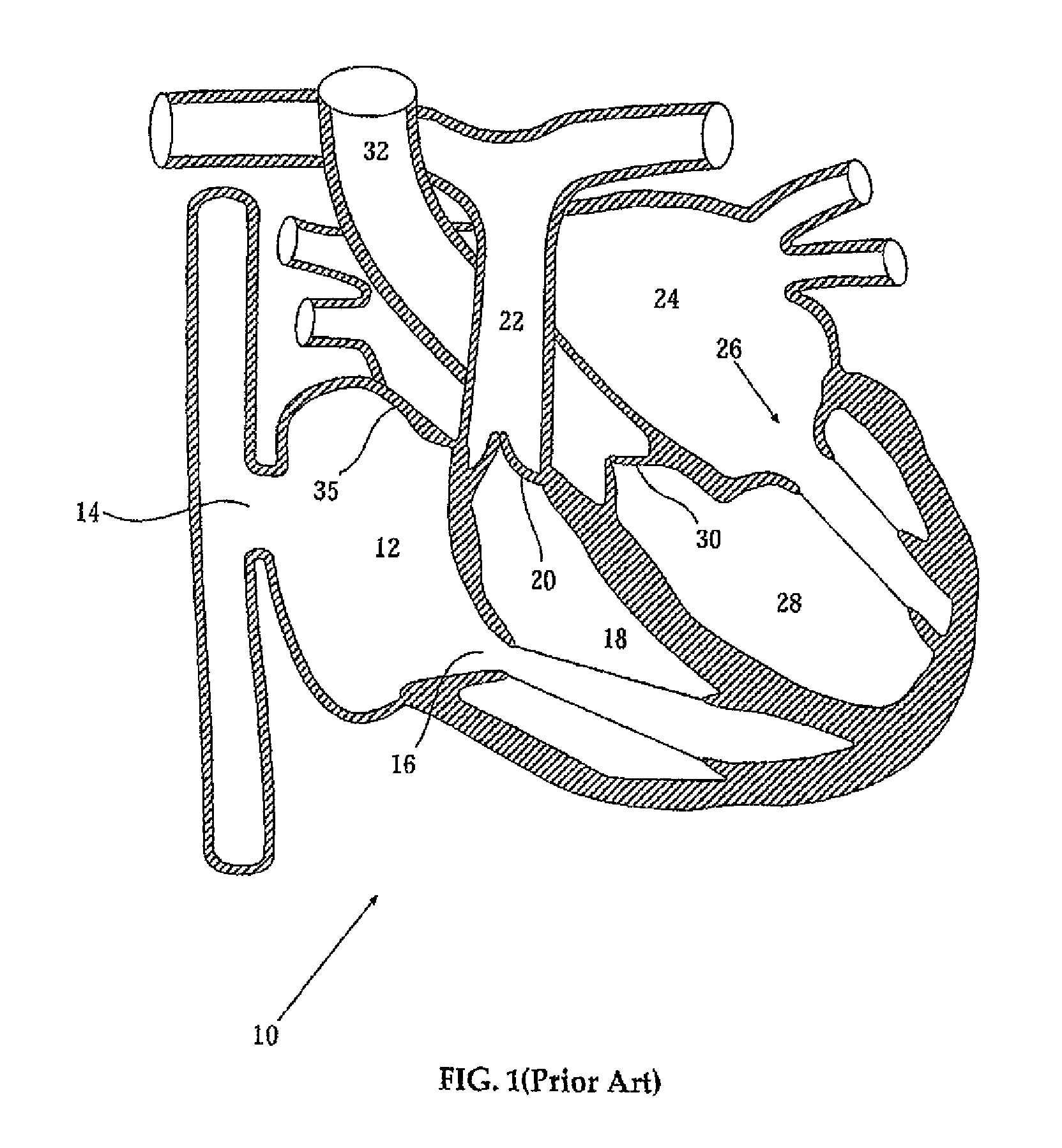 Elongated body for deployment in a heart