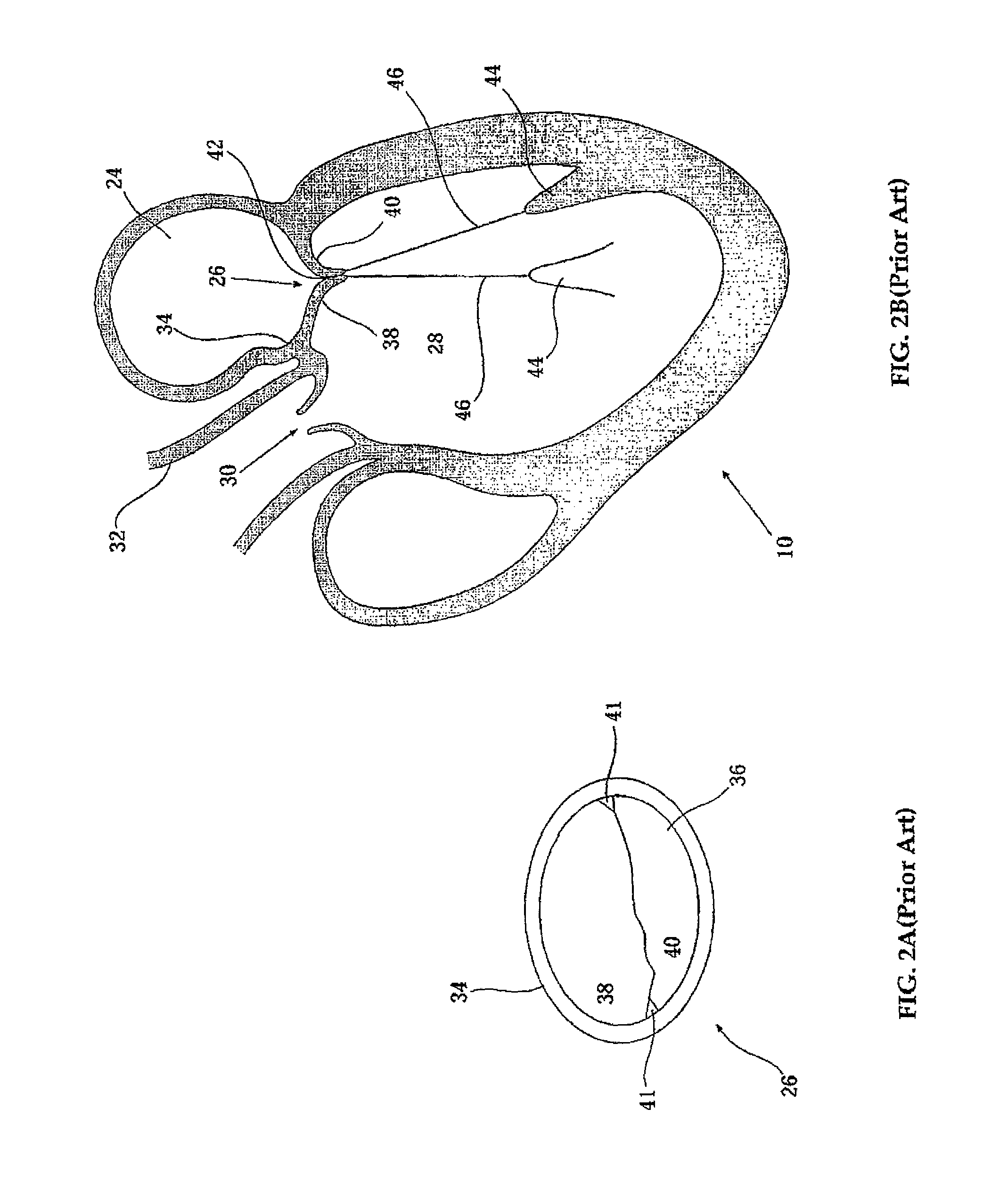 Elongated body for deployment in a heart