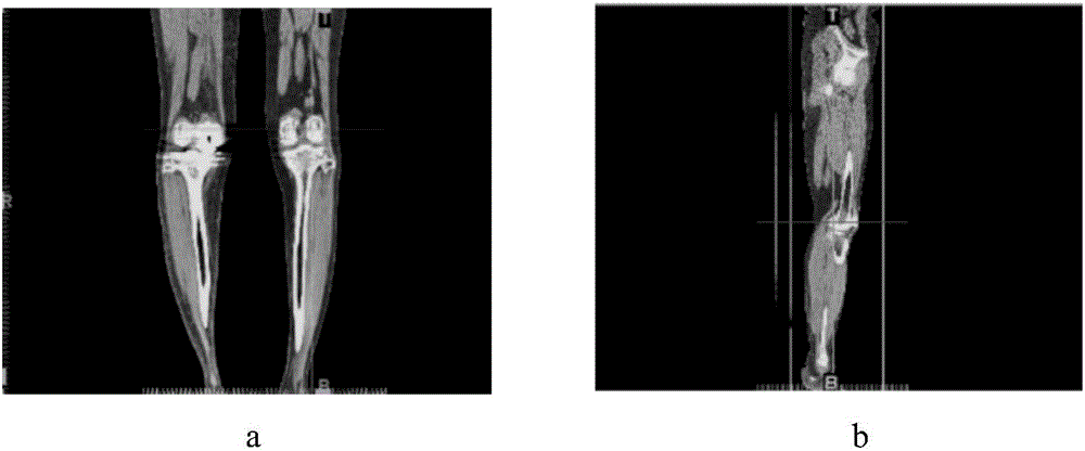 Virtual unicompartmental knee arthroplasty model construction method based on point-to-point registration technology