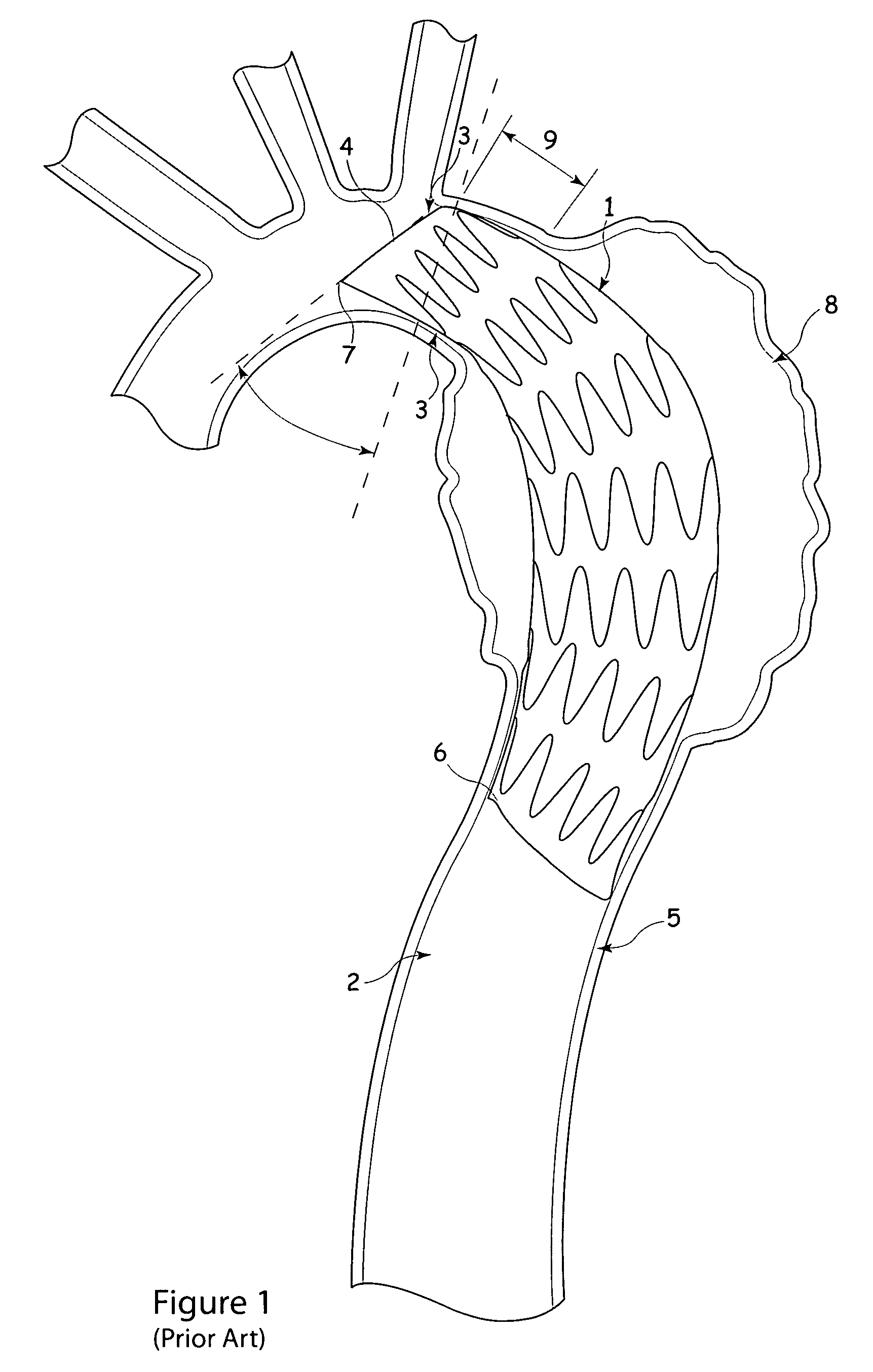 Introducer for endovascular grafts and stents