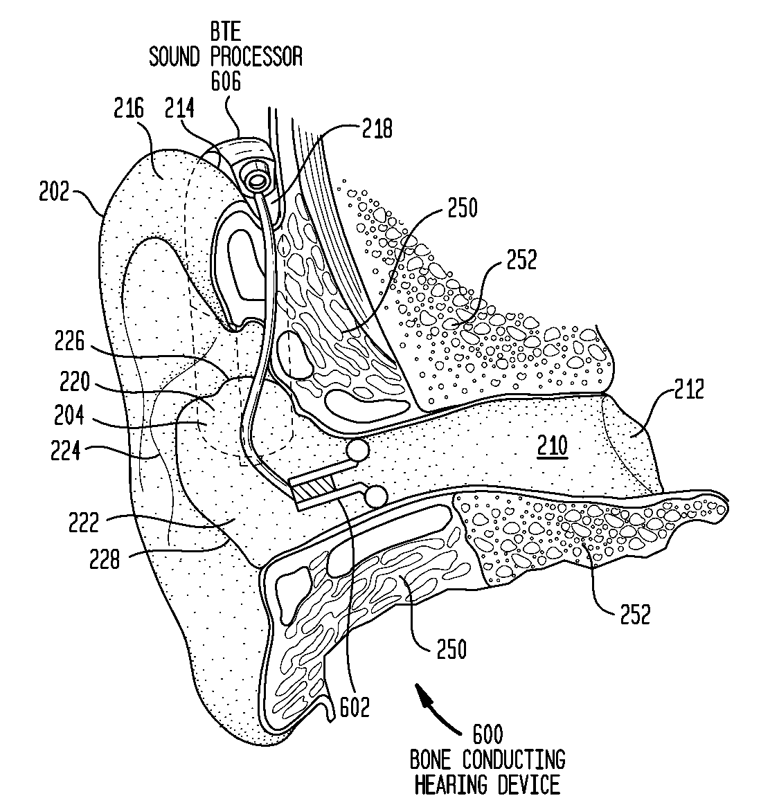 Hearing device having one or more in-the-canal vibrating extensions