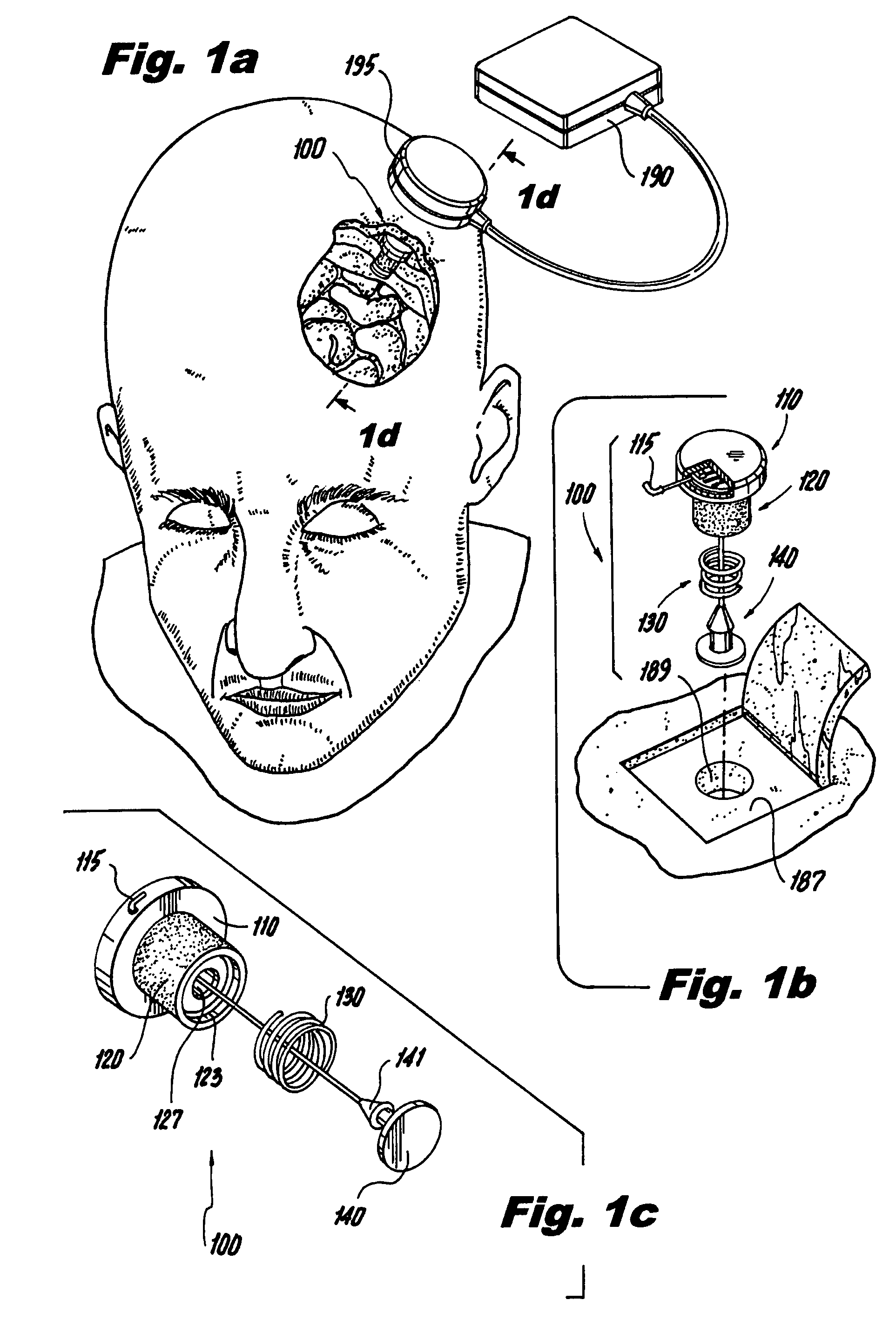 Implantable neurostimulation systems