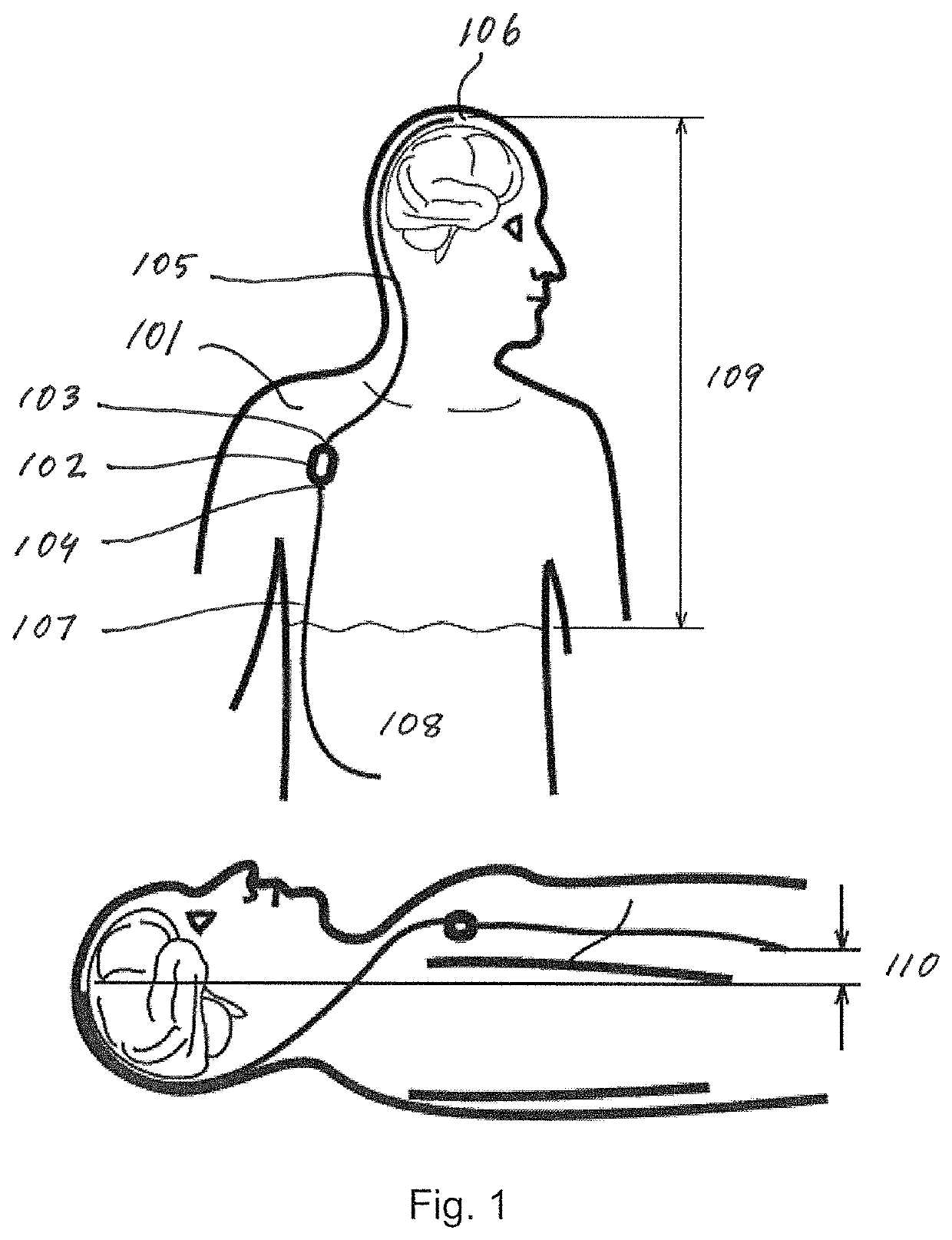 Cerebrospinal fluid shunt for treatment of hydrocephalus