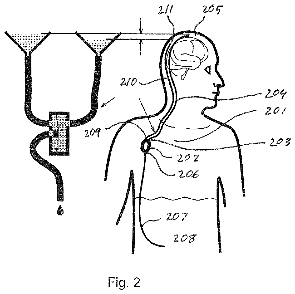 Cerebrospinal fluid shunt for treatment of hydrocephalus