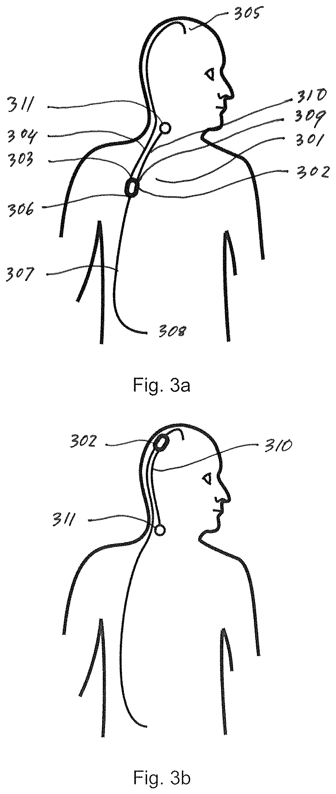 Cerebrospinal fluid shunt for treatment of hydrocephalus