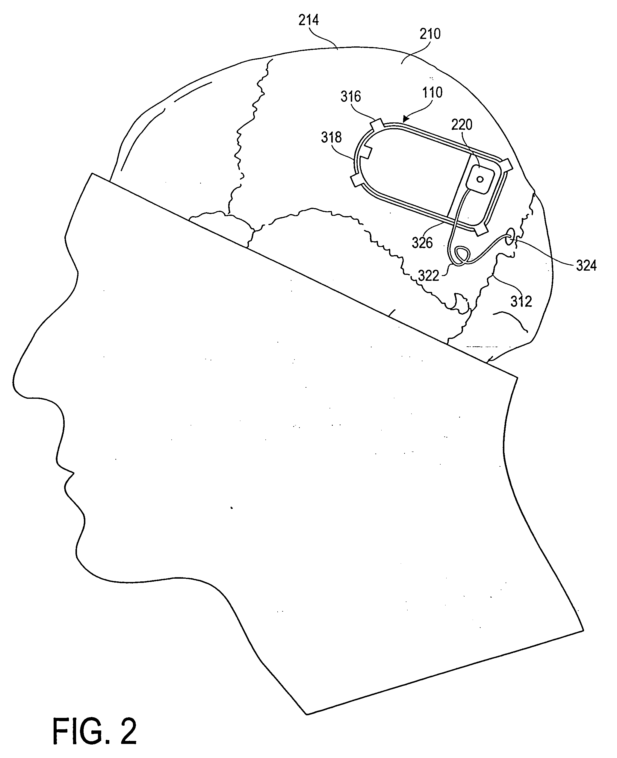 Treatment and warning of recurring therapy and other events using an implantable device