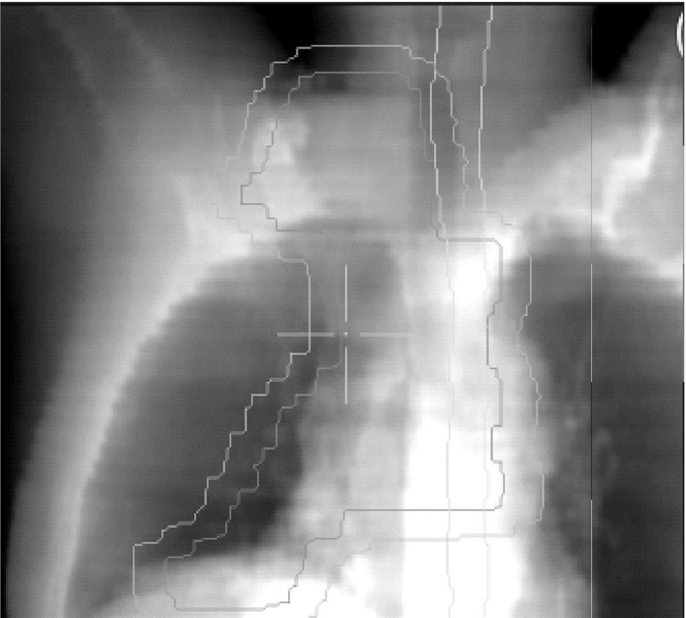 Shooting and Verification Method of Intensity Modulated Radiation Field Confirmation Film