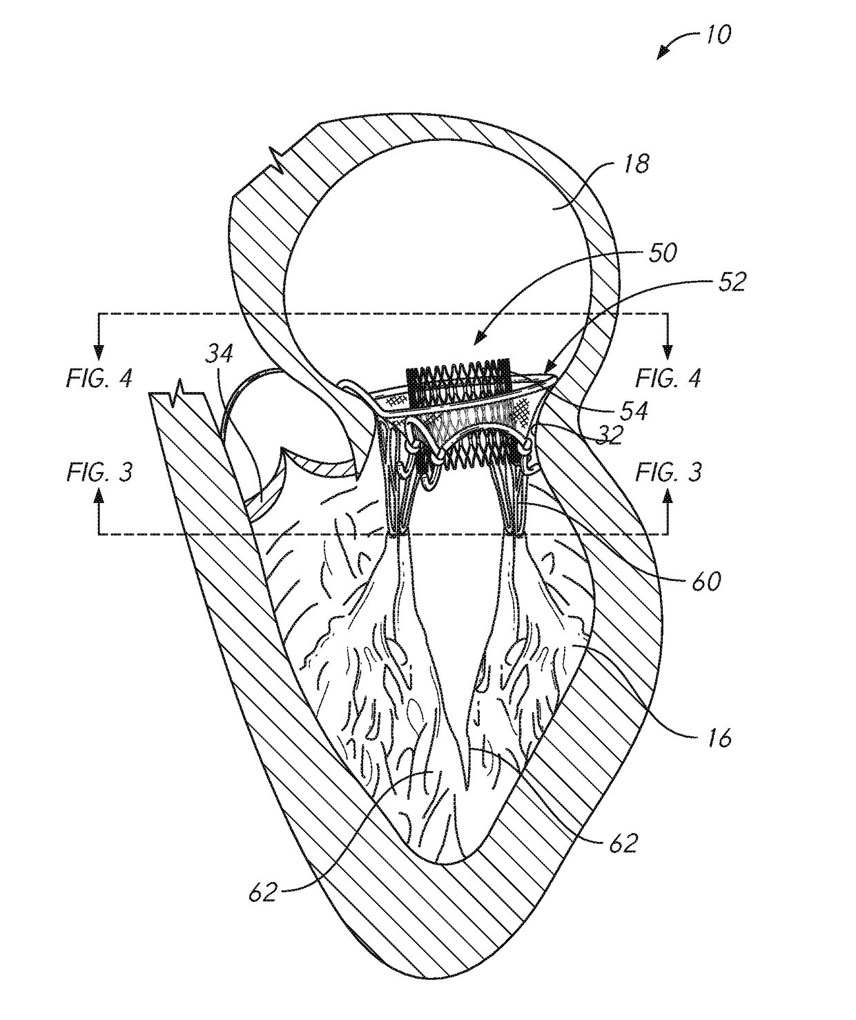 Mitral valve prosthesis