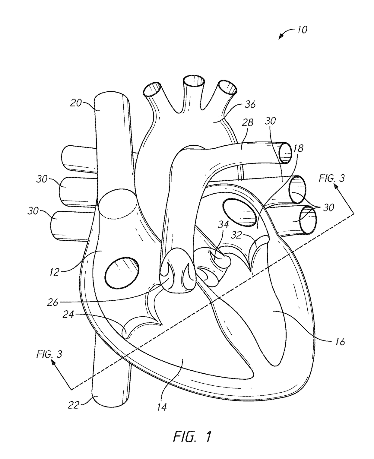 Mitral valve prosthesis