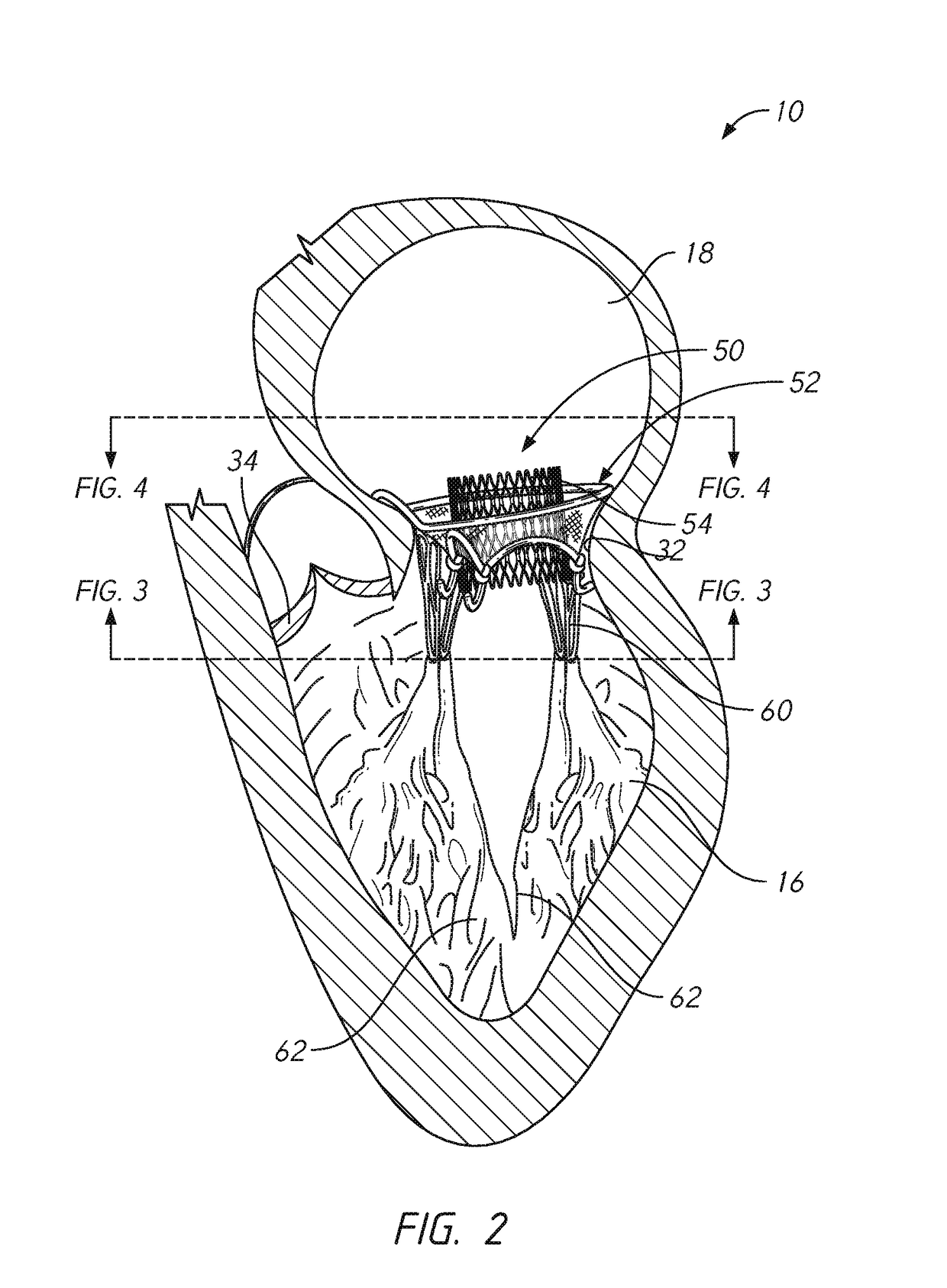 Mitral valve prosthesis