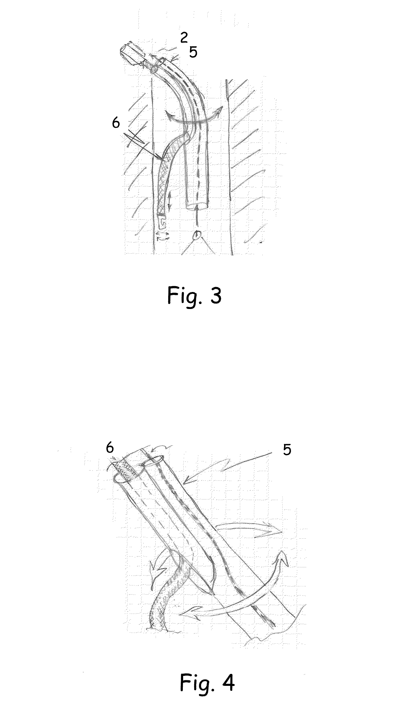 Multi lumen IVC filter retrieval device