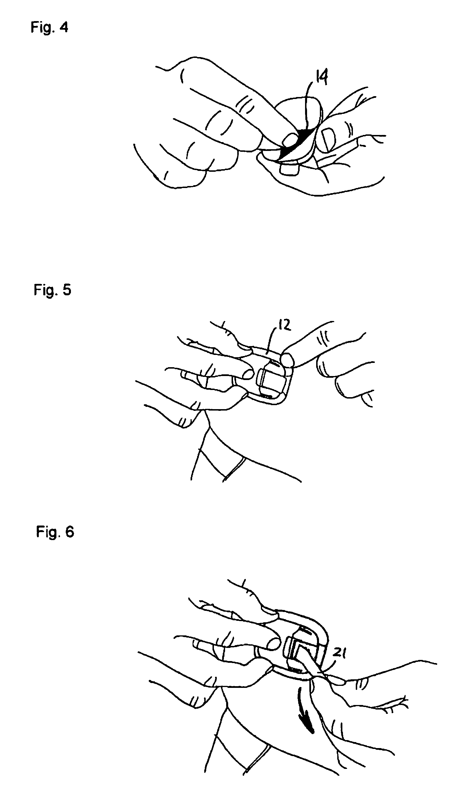 Retraction means for transcutaneous device