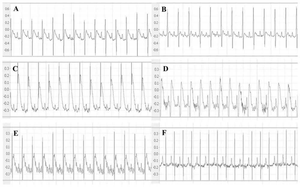 Application of curcumin metabolites in the preparation of drugs for the treatment of myocardial ischemia-related injuries