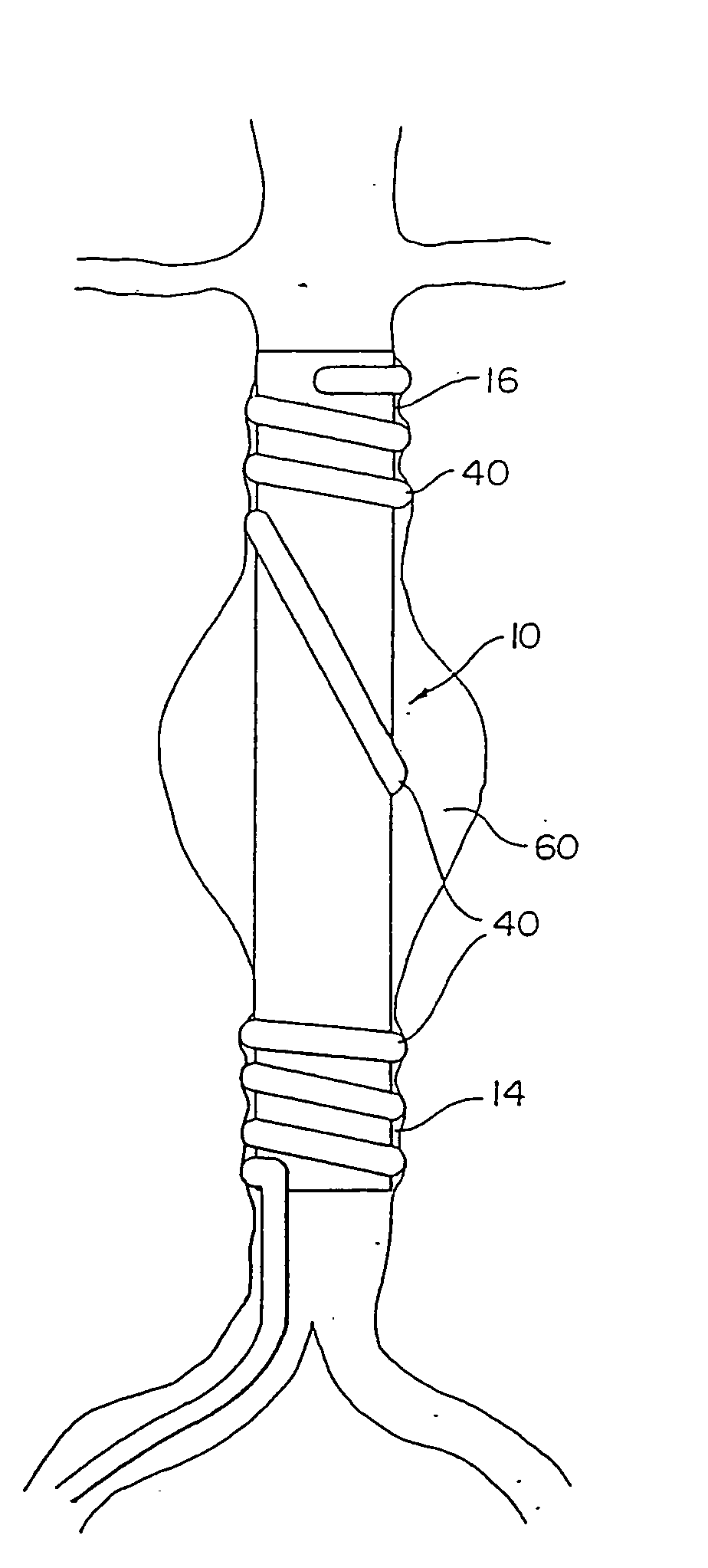 Endovascular apparatus