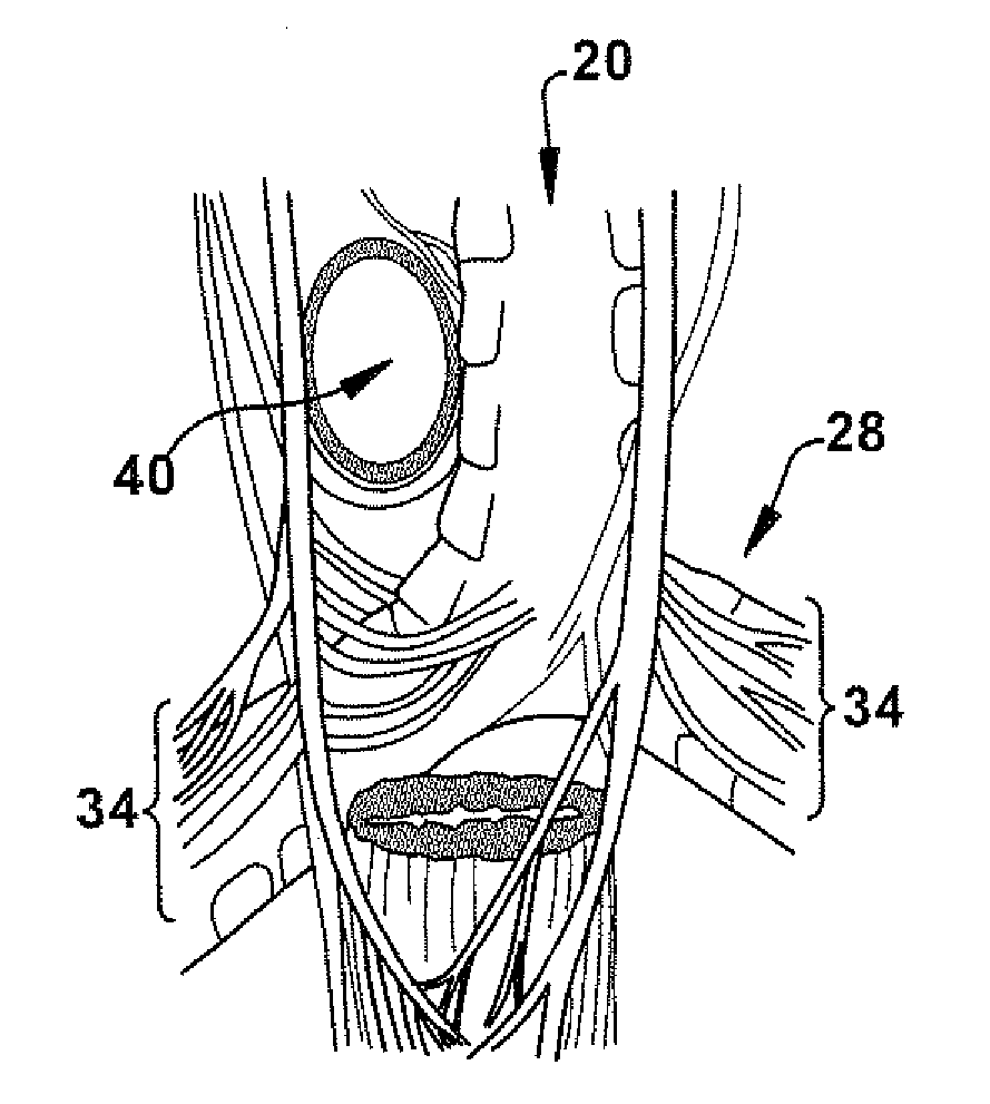 Apparatus and method for treating pulmonary conditions