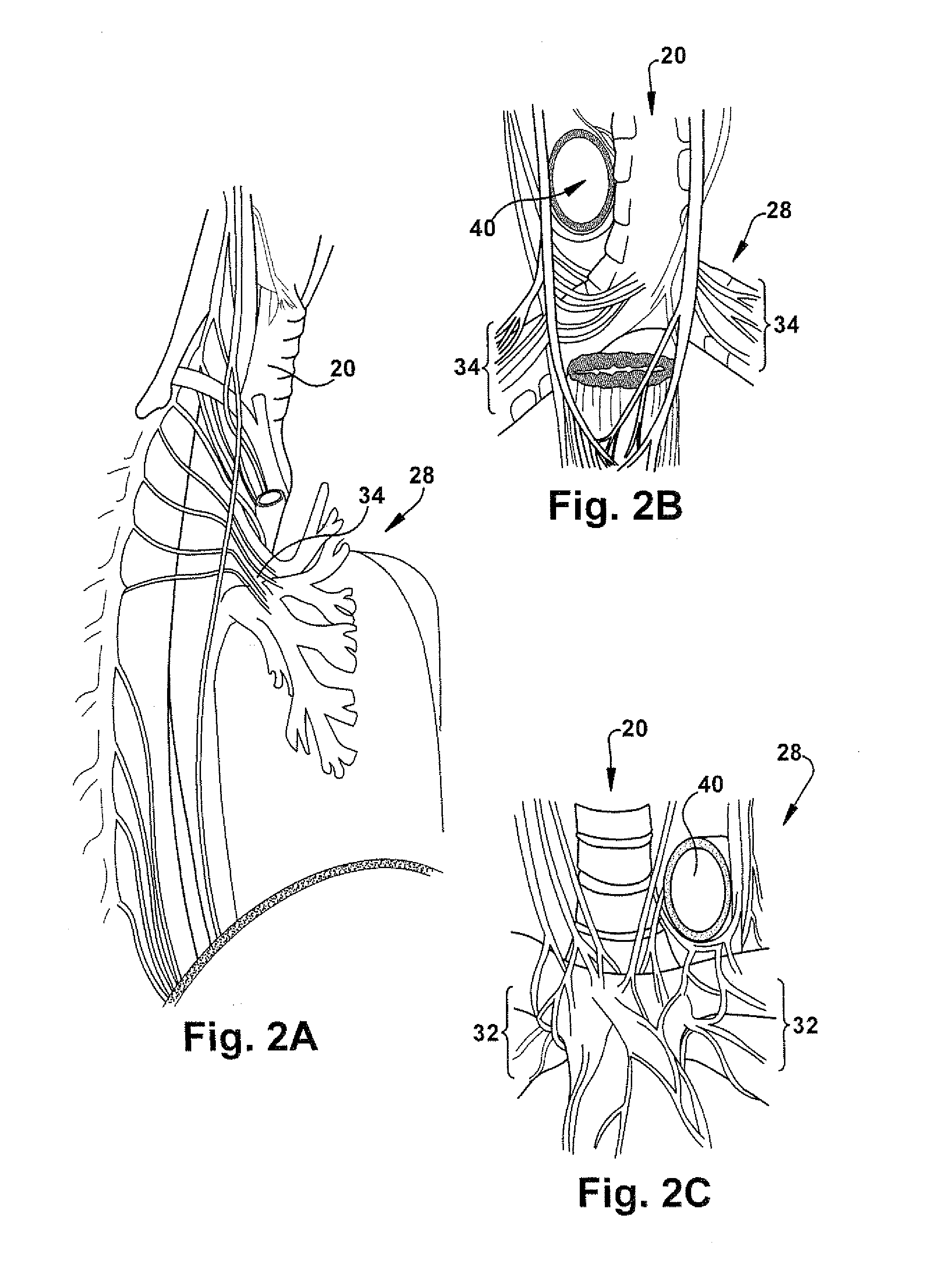 Apparatus and method for treating pulmonary conditions