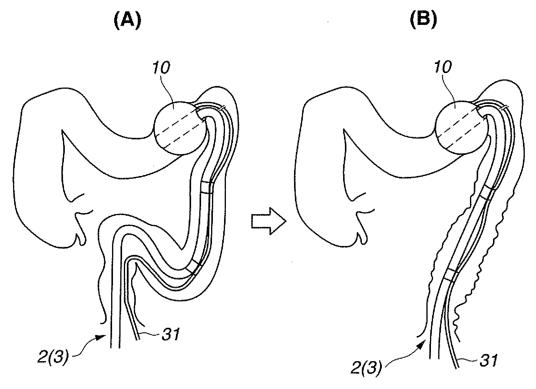 Endoscope insertion support tool and endoscope device