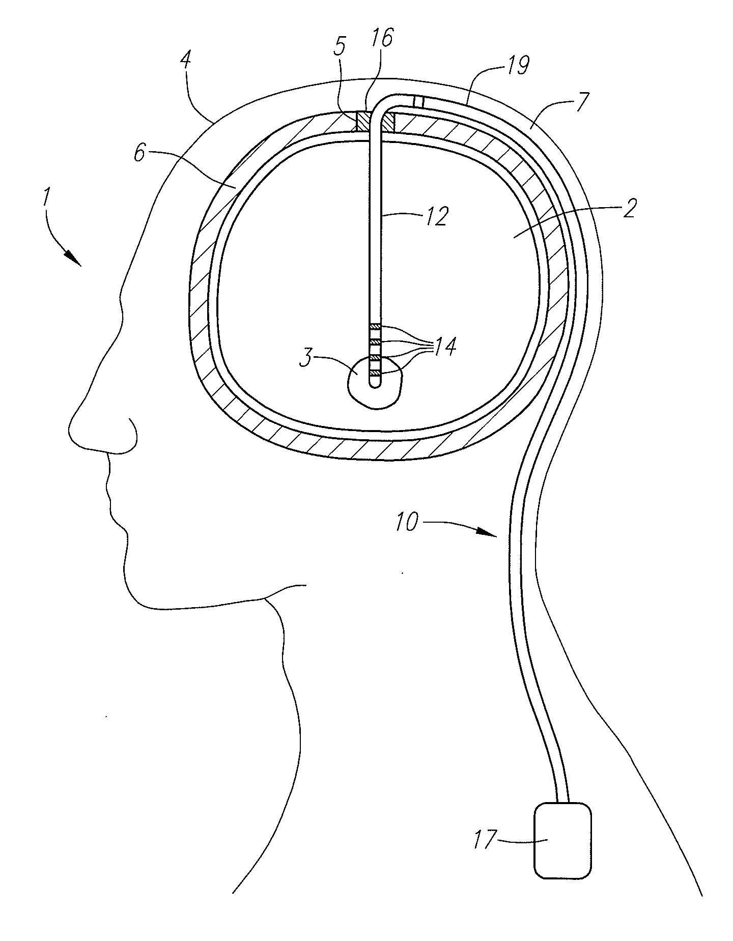 Cam lock burr hole plug for securing stimulation lead