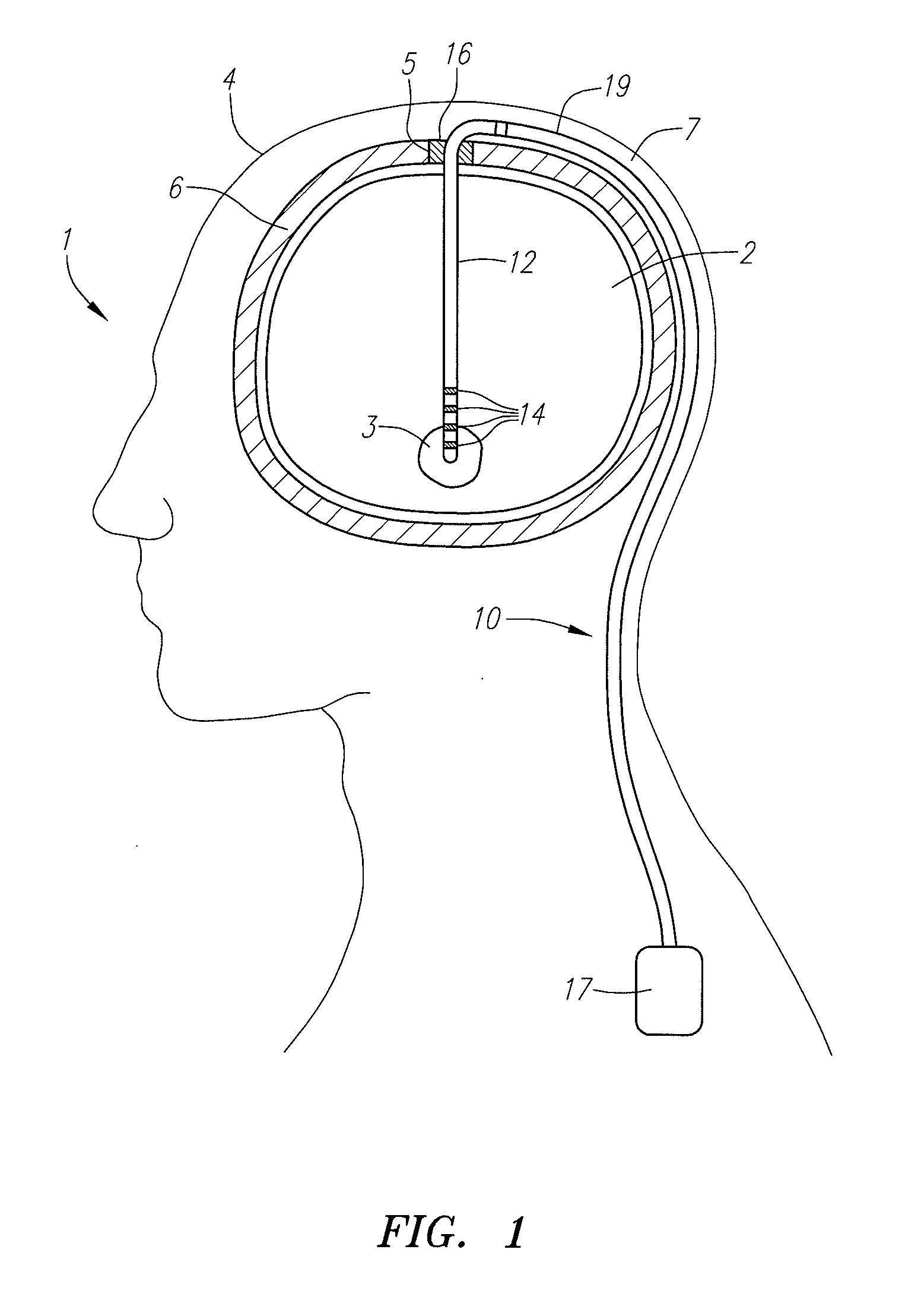 Cam lock burr hole plug for securing stimulation lead