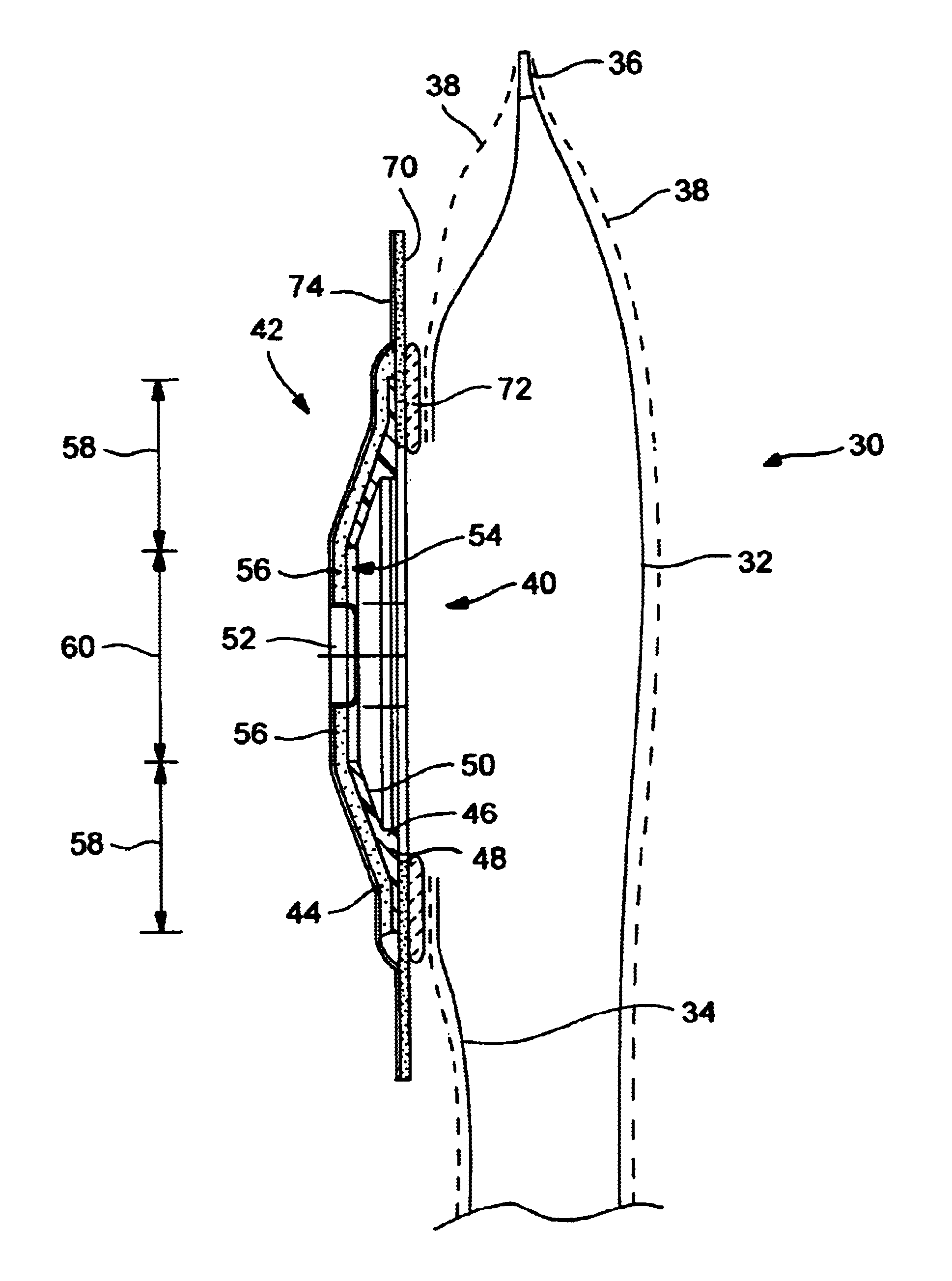 Ostomy appliance