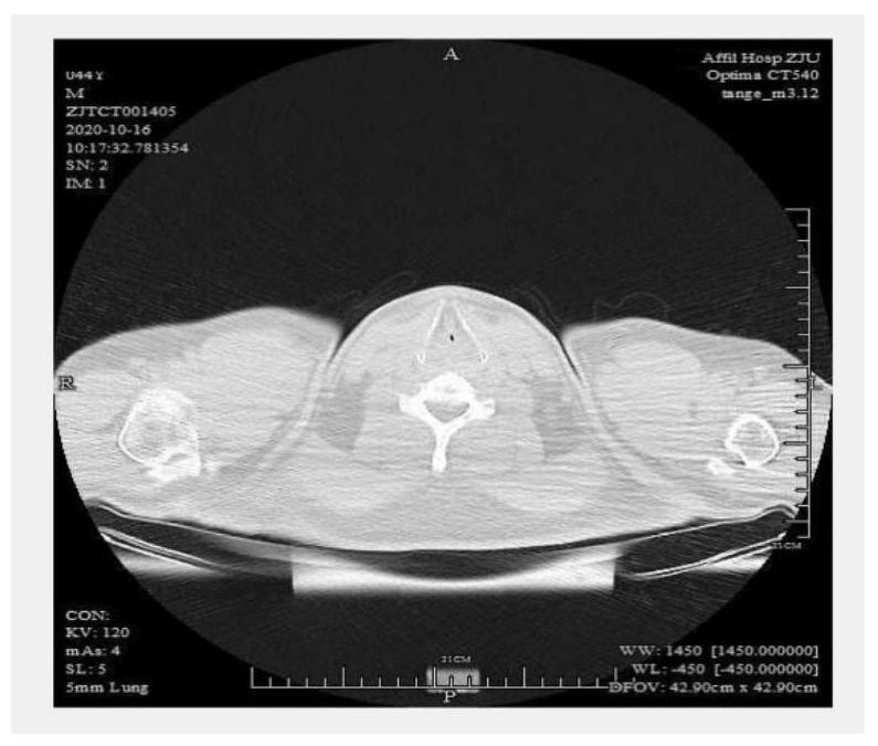 High-precision semi-automatic blood vessel 3D reconstruction algorithm based on CT image