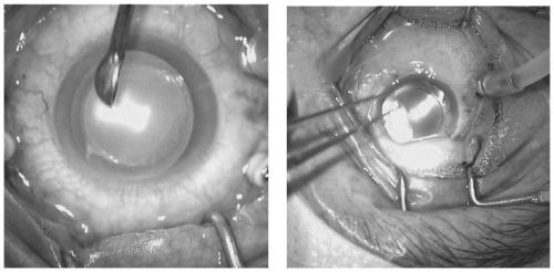 Corneal bandage lens and preparation method thereof