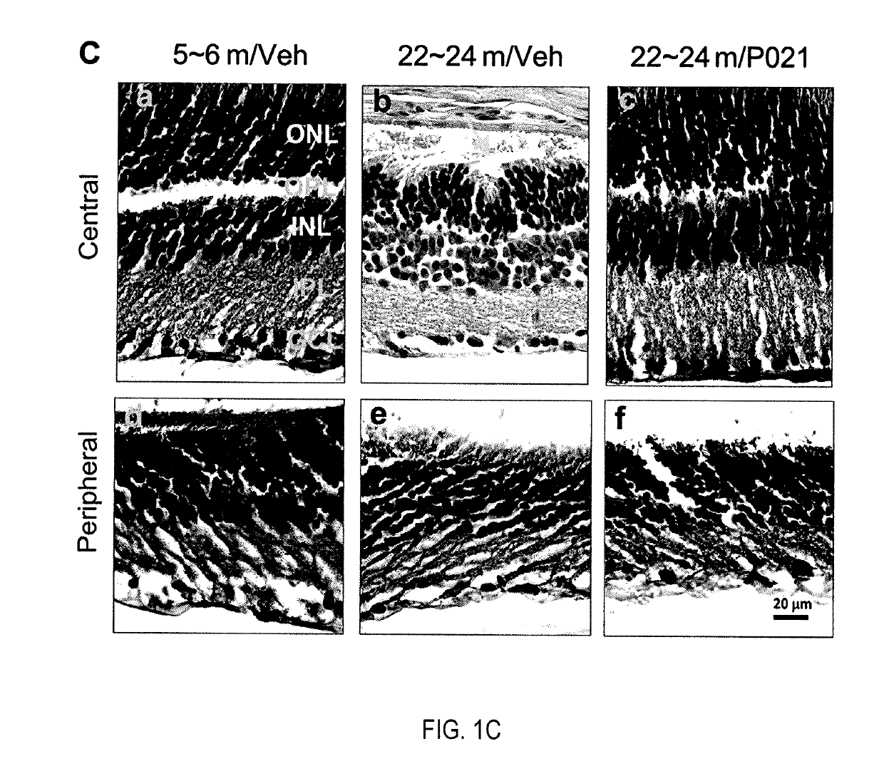 Treatment of age-related macular degeneration with neurotrophic peptidergic compound