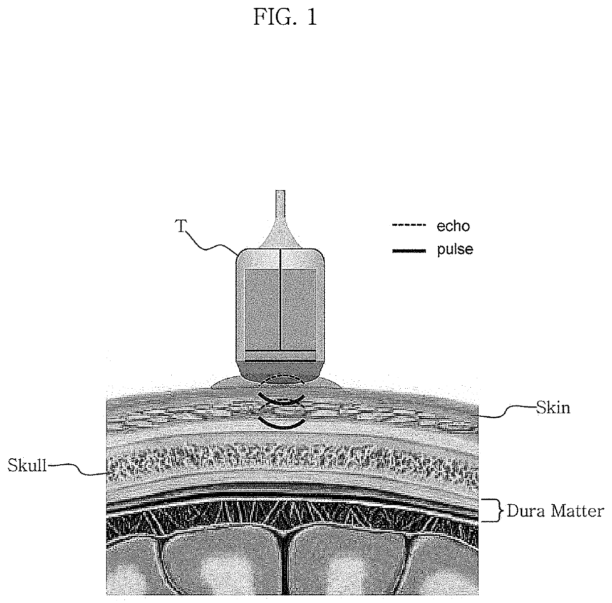 Non-invasive treatment system using intermedium