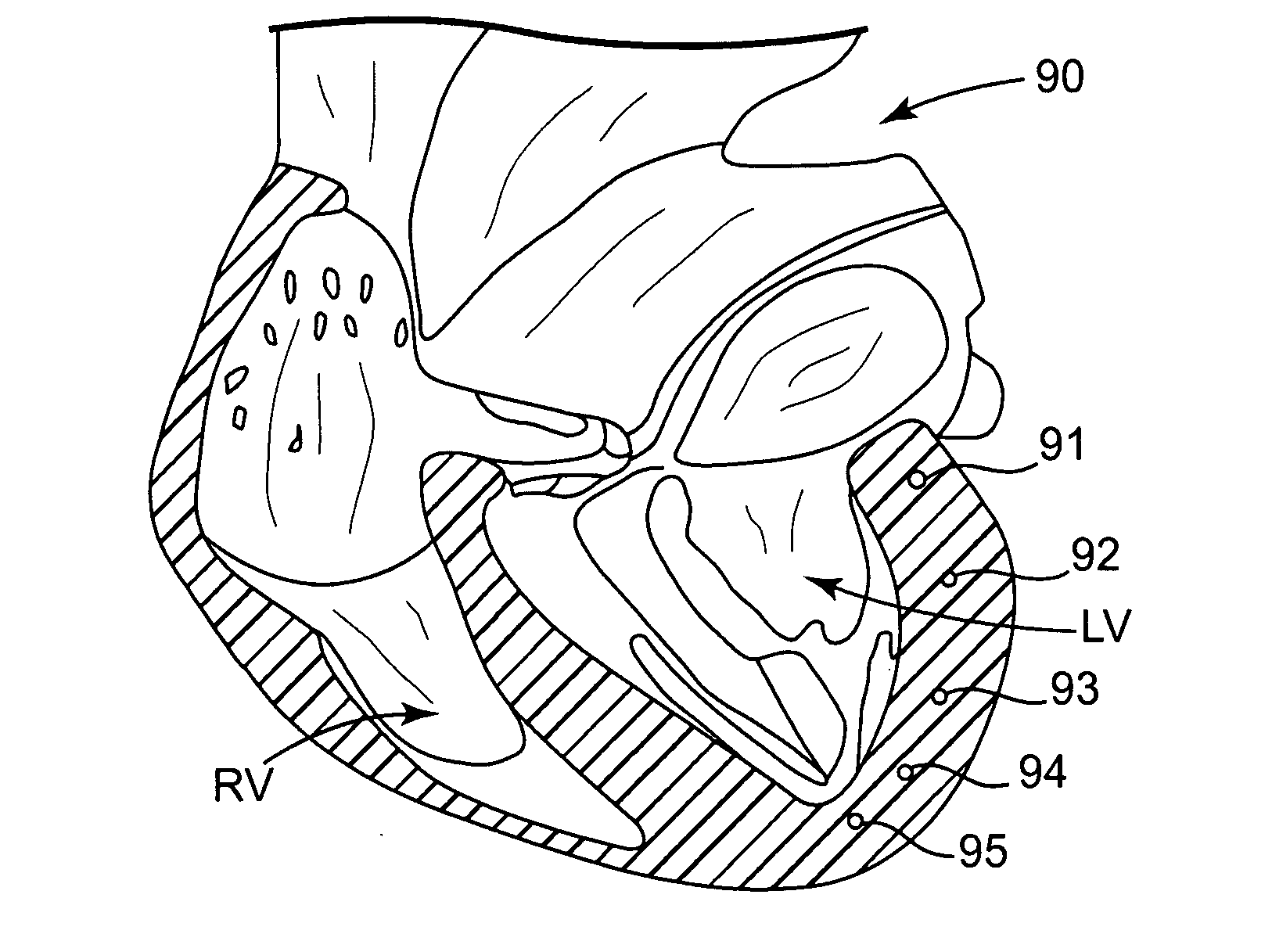 Intramyocardial patterning for global cardiac resizing and reshaping