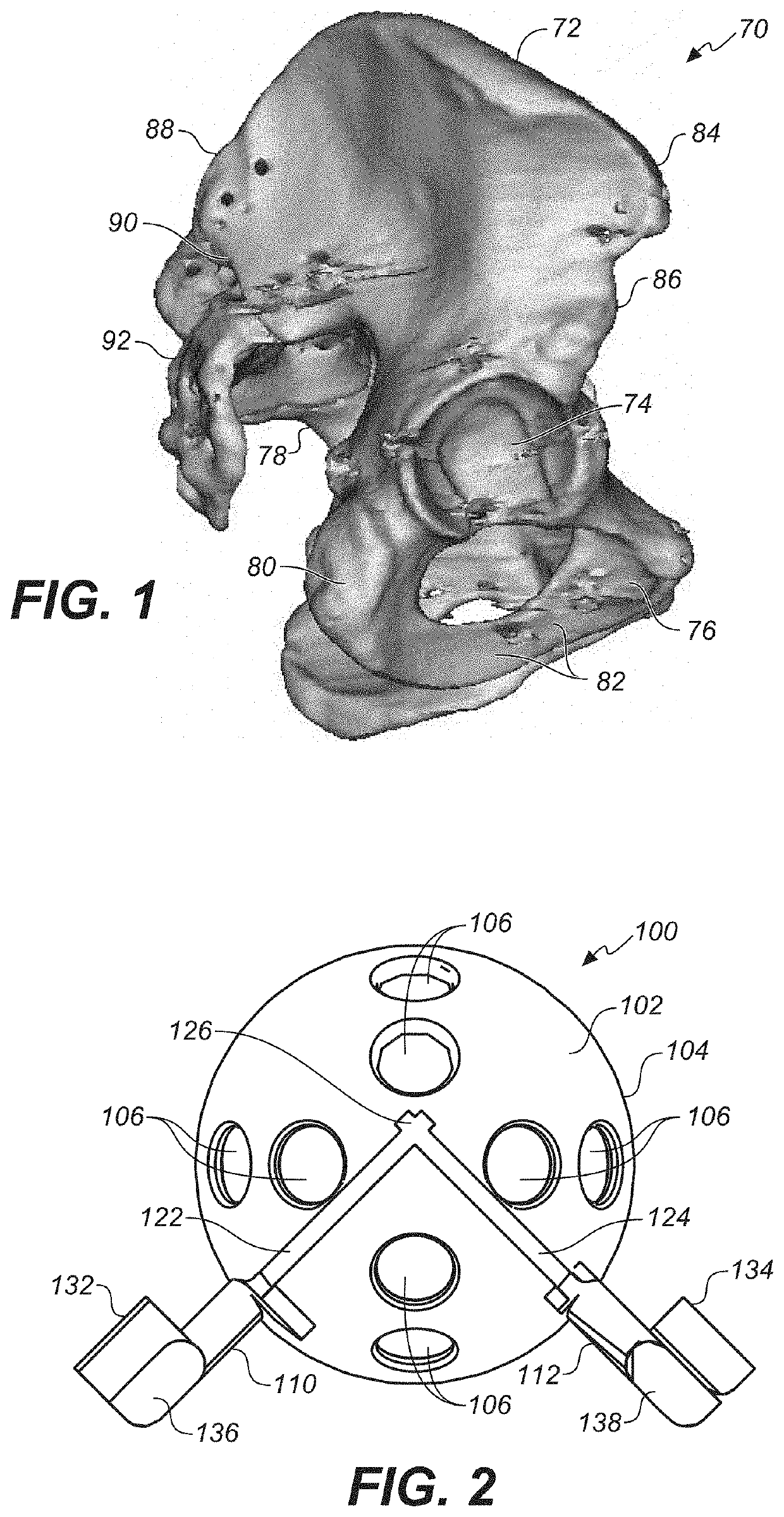 Bone cutting guide system for osteochondral transplantation