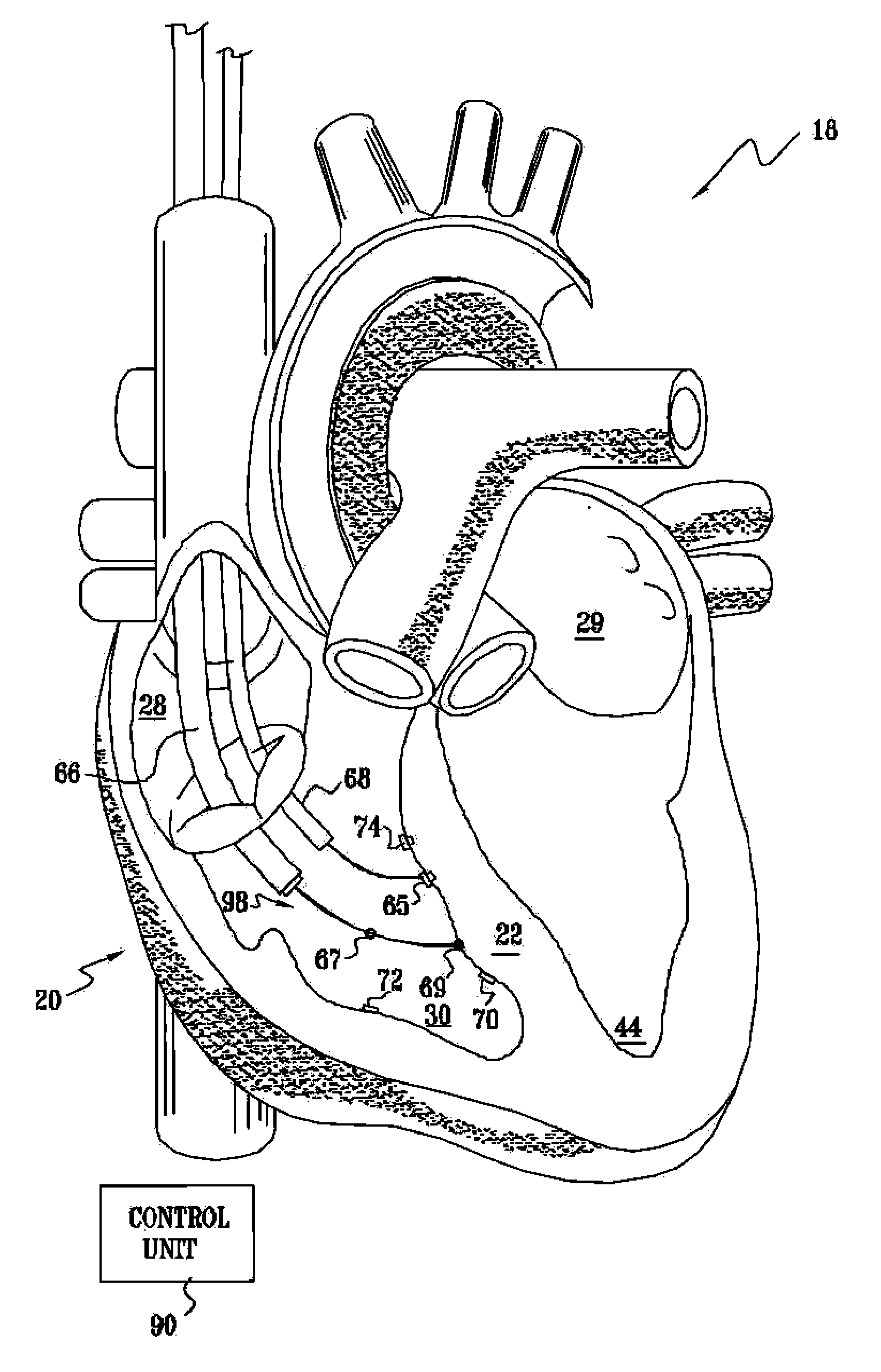 Signal Delivery Through The Right Ventricular Septum