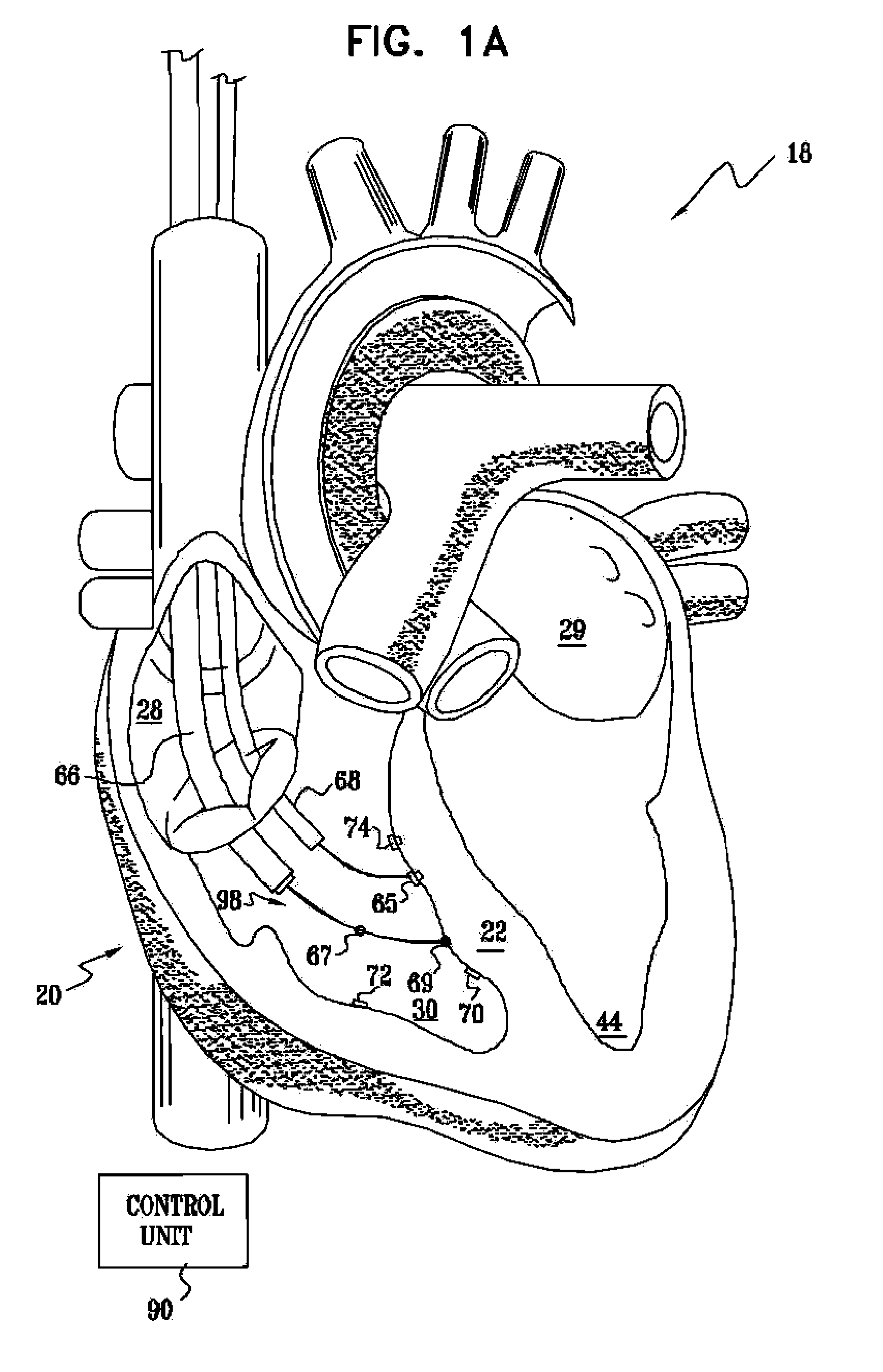 Signal Delivery Through The Right Ventricular Septum