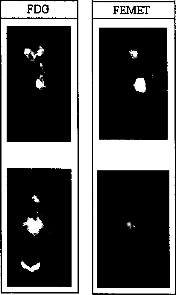 Tumour positive electron developer S-(18 fluro-n-alkyl)-L-methionine and its preparation method