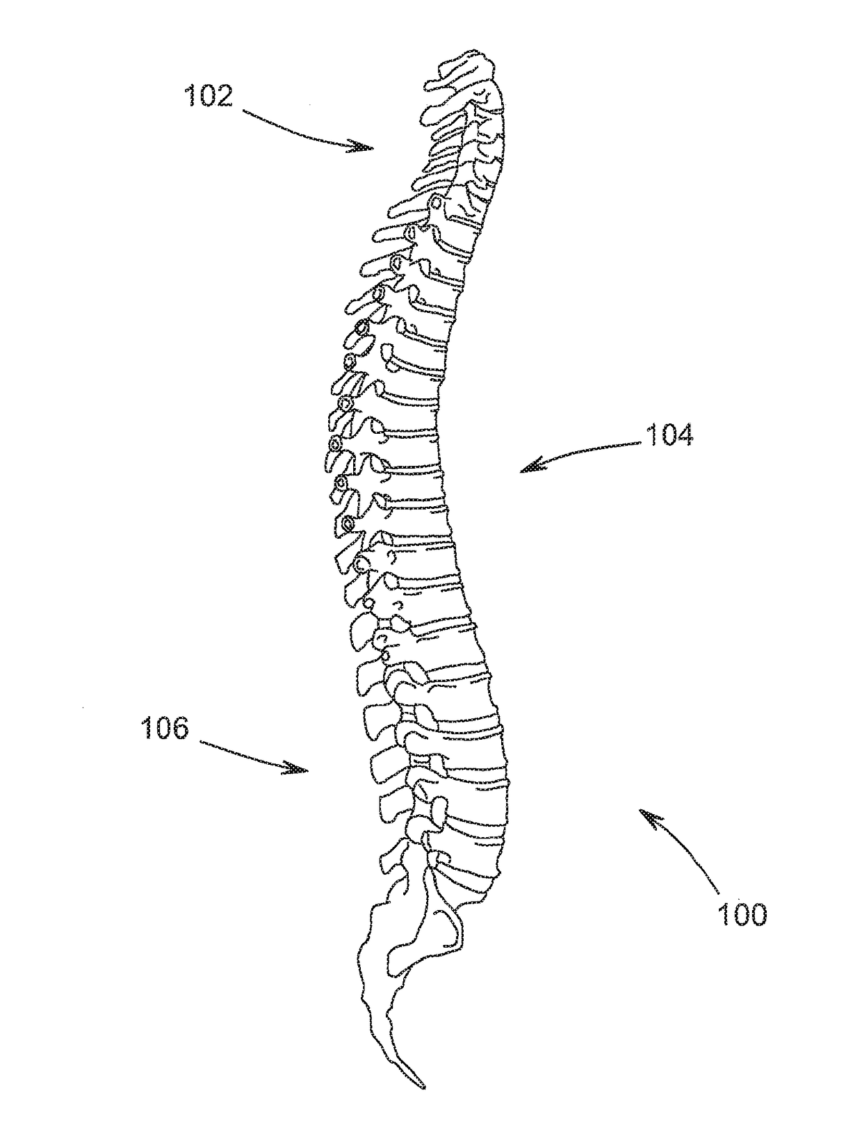 Device and Method for Treatment of Spondylotic Disease