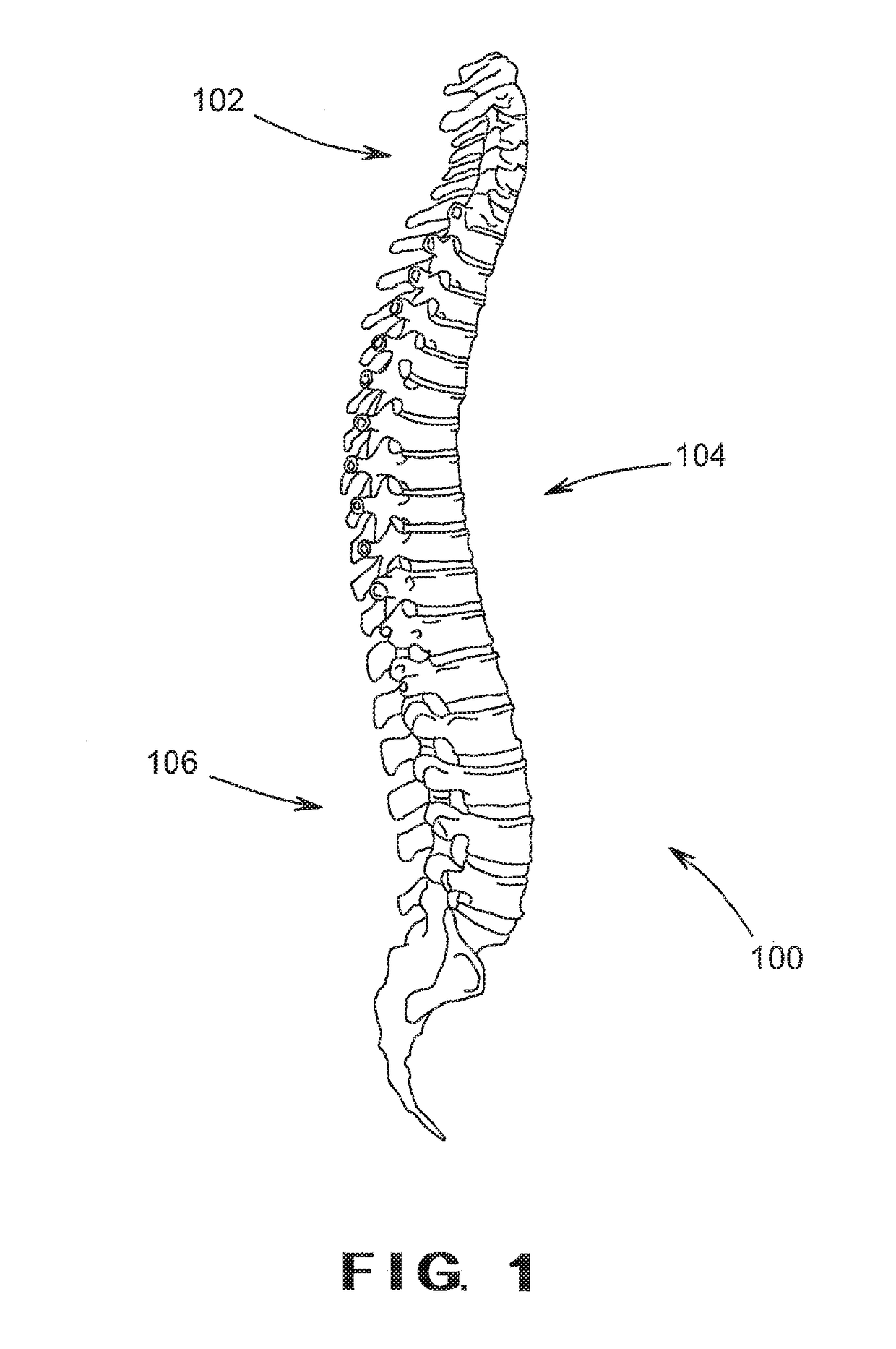 Device and Method for Treatment of Spondylotic Disease